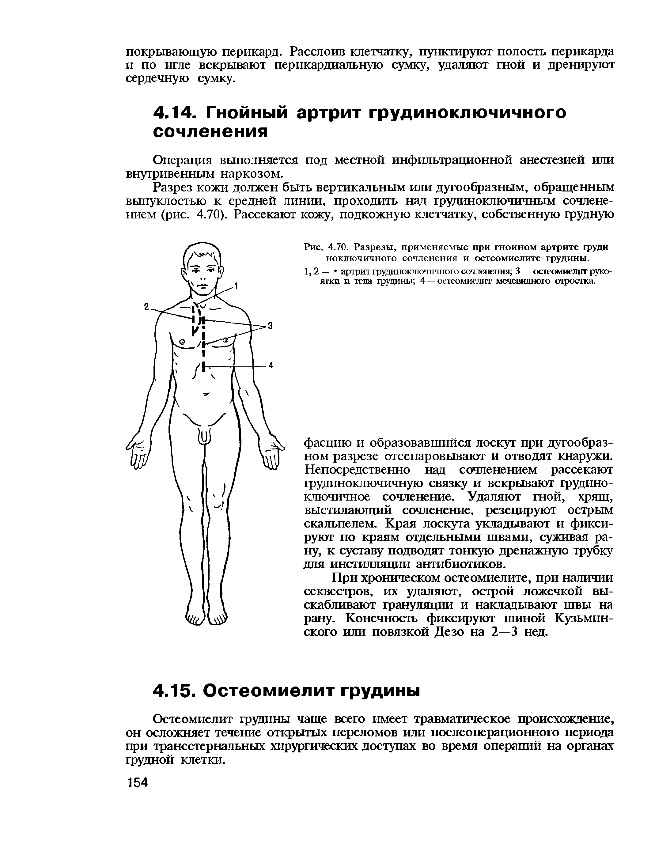 Рис. 4.70. Разрезы, применяемые при гнойном артрите груди ноключичного сочленения и остеомиелите грудины.