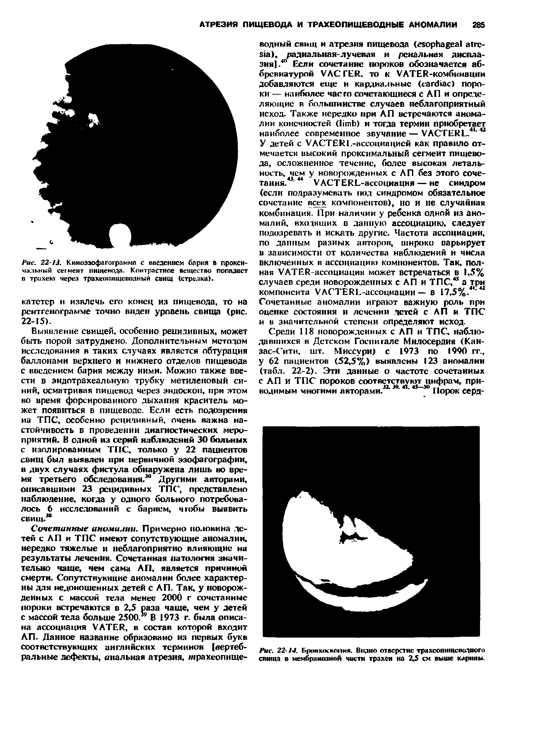 Рис. 22- /Д. Бронхоскопия. Видно отверстие трахеопищеводного свища о мембранозной части трахеи на 2.5 см выше Корины.