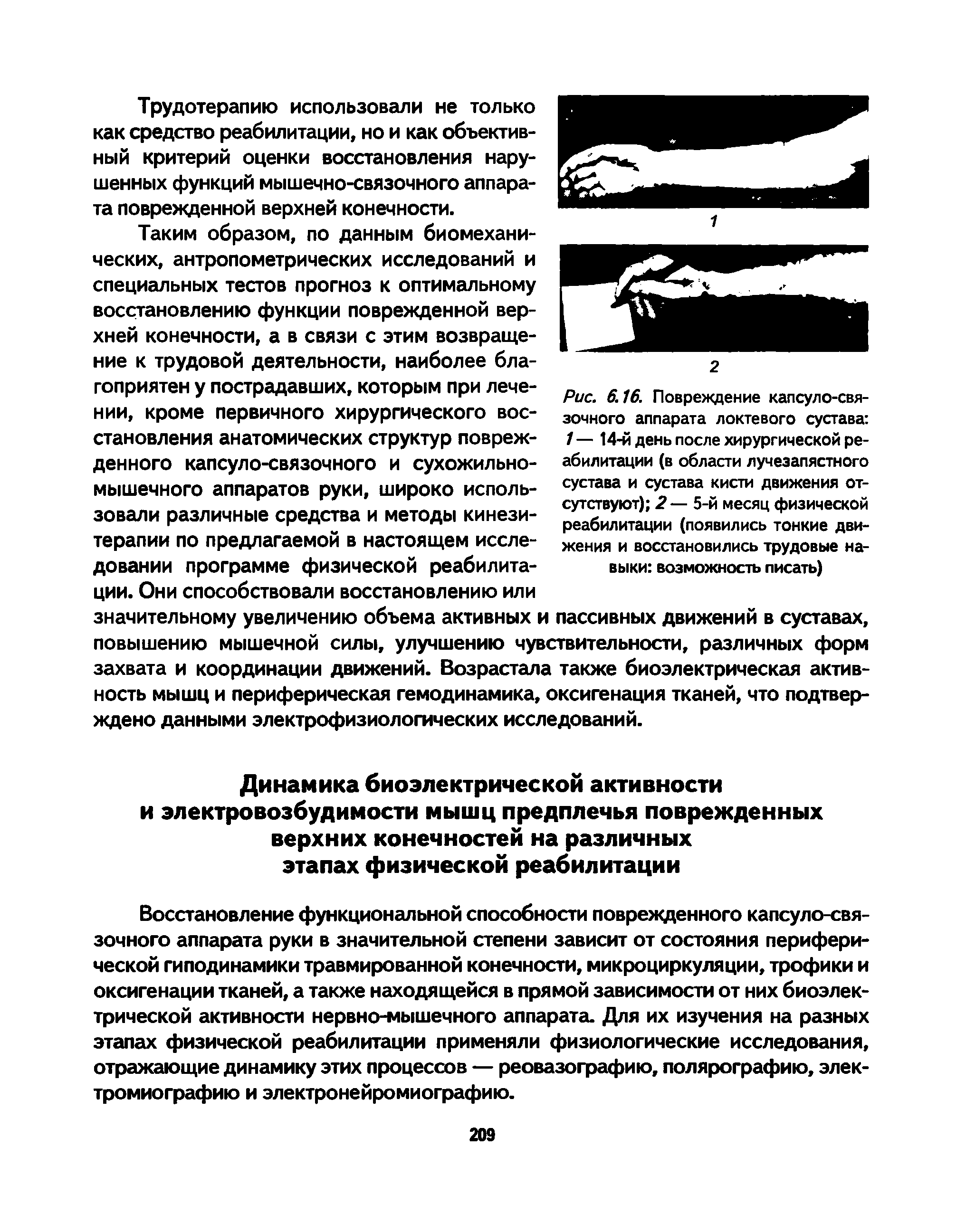 Рис. 6.16. Повреждение капсуло-связочного аппарата локтевого сустава 1 — 14-й день после хирургической реабилитации (в области лучезапястного сустава и сустава кисти движения отсутствуют) 2 — 5-й месяц физической реабилитации (появились тонкие движения и восстановились трудовые навыки возможность писать)...