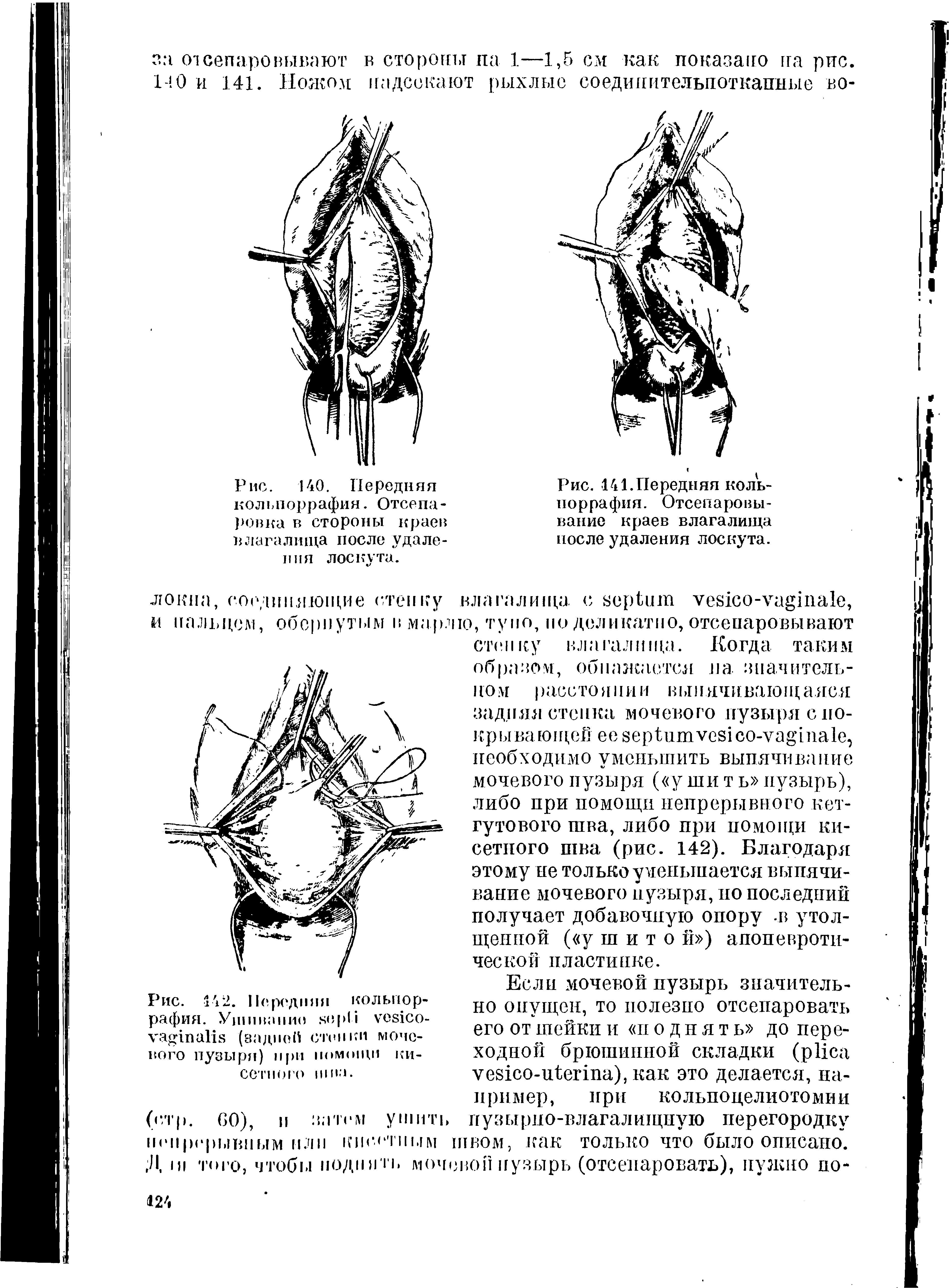 Рис. 142. Передняя кольпоррафия. Ушивание - (задней стенки мочевого пузыря) при помощи кисетного III ня.