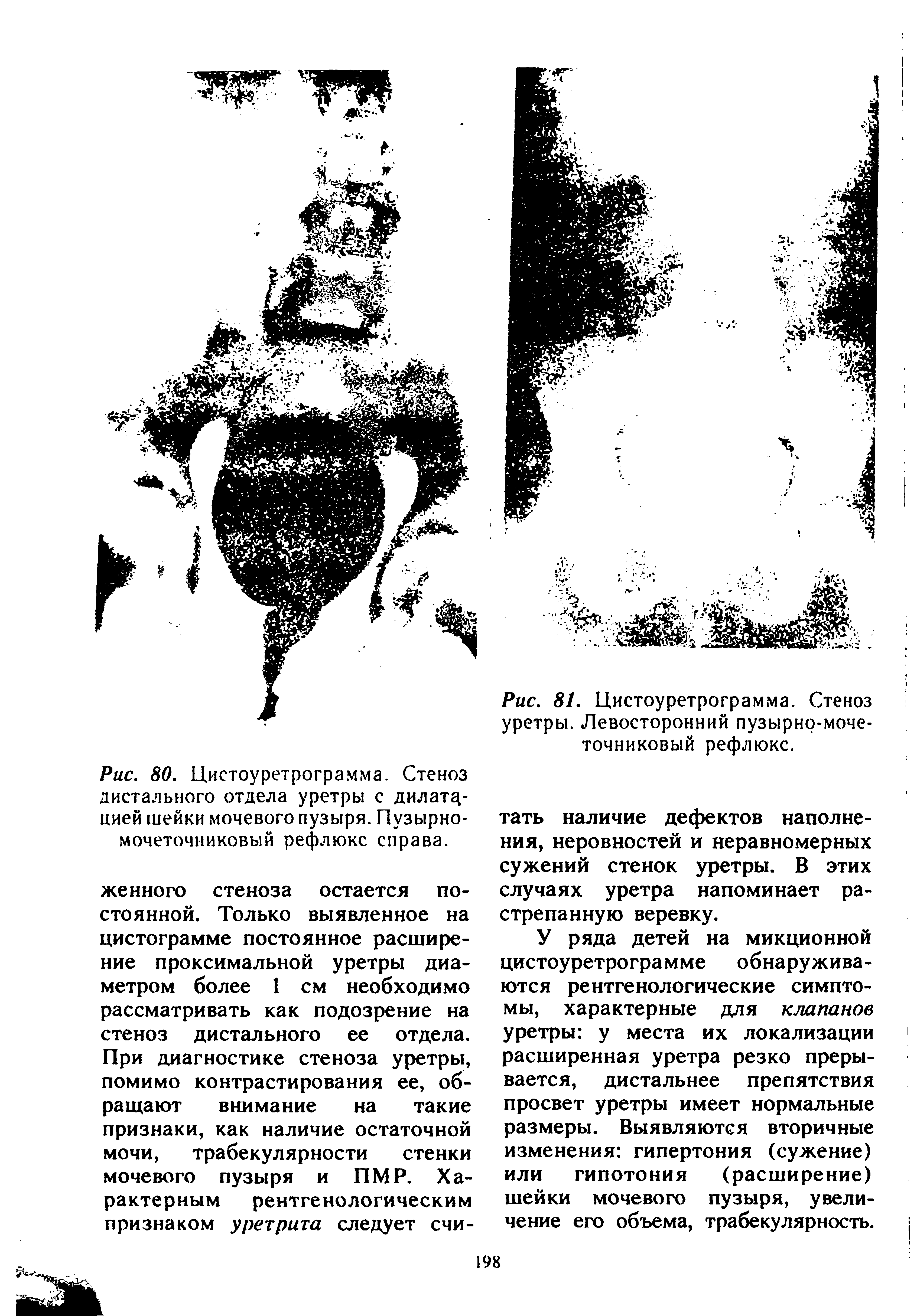 Рис. 81. Цистоуретрограмма. Стеноз уретры. Левосторонний пузырно-мочеточниковый рефлюкс.