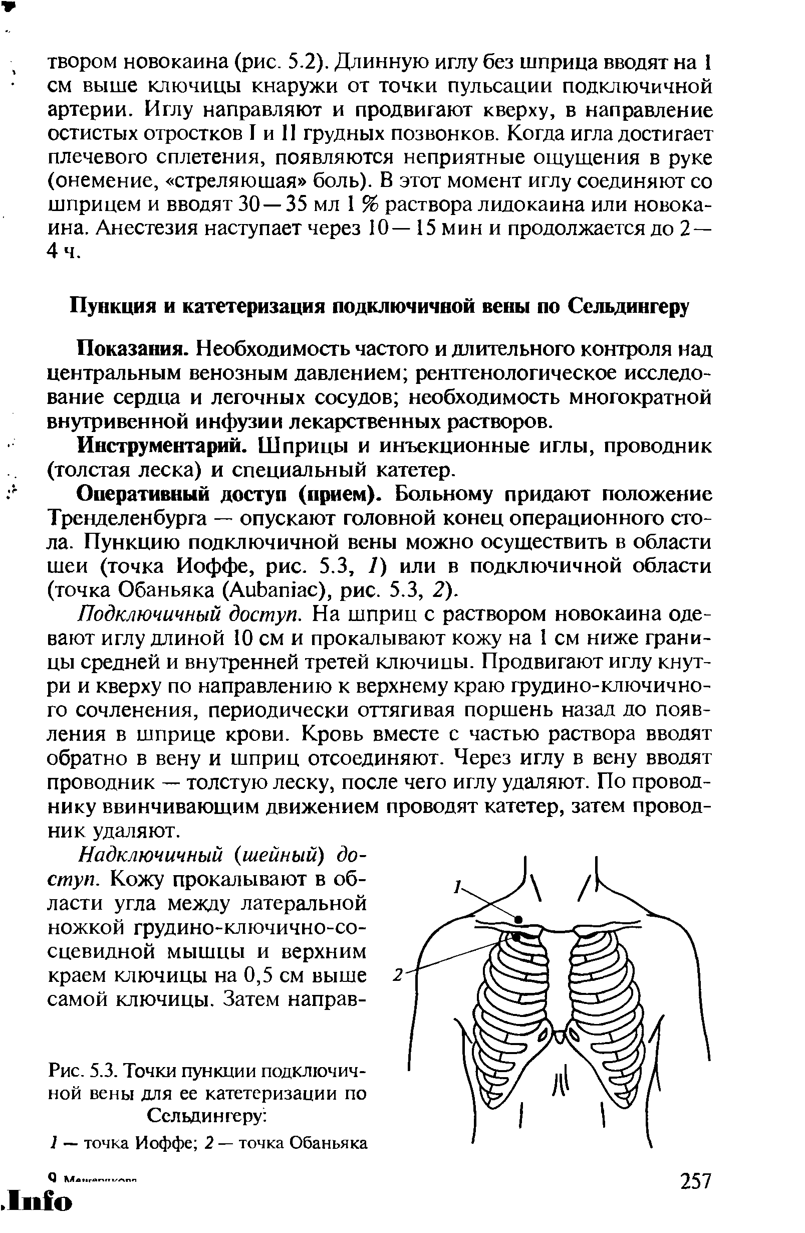 Рис. 5.3. Точки пункции подключичной вены для ее катетеризации по Сельдингеру ...