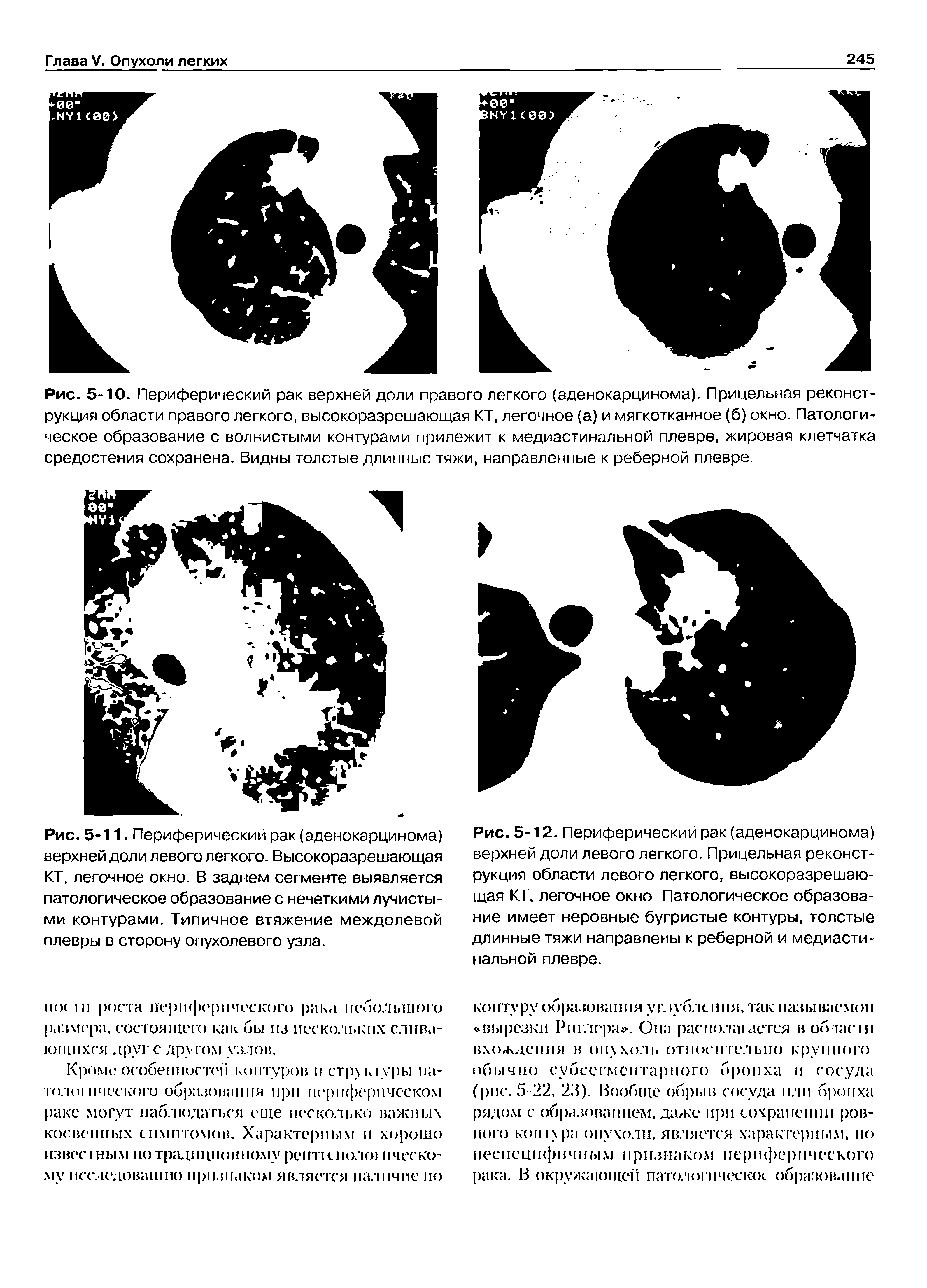 Рис. 5-11. Периферический рак (аденокарцинома) верхней доли левого легкого. Высокоразрешающая КТ, легочное окно. В заднем сегменте выявляется патологическое образование с нечеткими лучистыми контурами. Типичное втяжение междолевой плевры в сторону опухолевого узла.