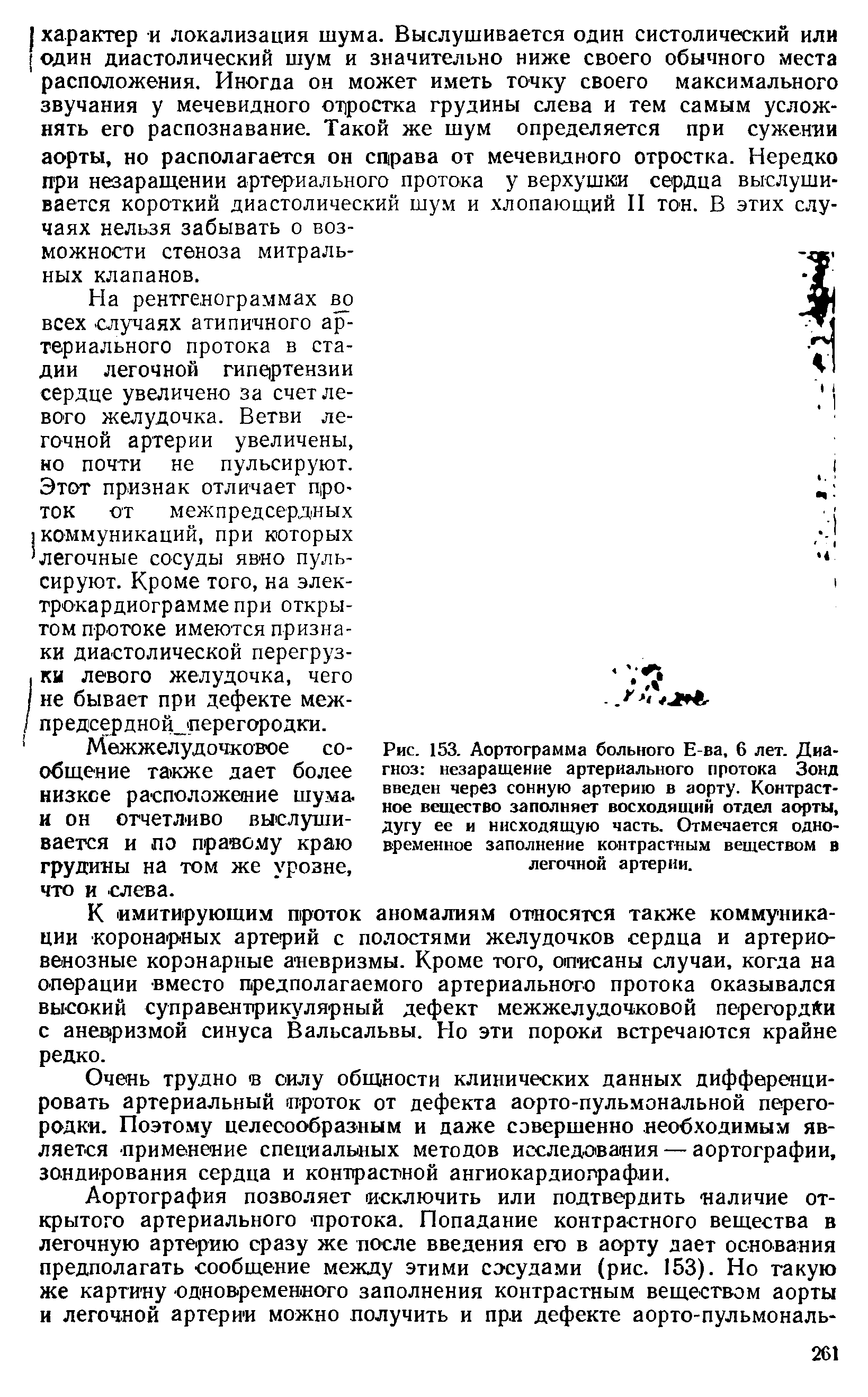 Рис. 153. Аортограмма больного Е-ва, 6 лет. Диагноз незаращение артериального протока Зонд введен через сонную артерию в аорту. Контрастное вещество заполняет восходящий отдел аорты, дугу ее и нисходящую часть. Отмечается одновременное заполнение контрастным веществом в легочной артерии.