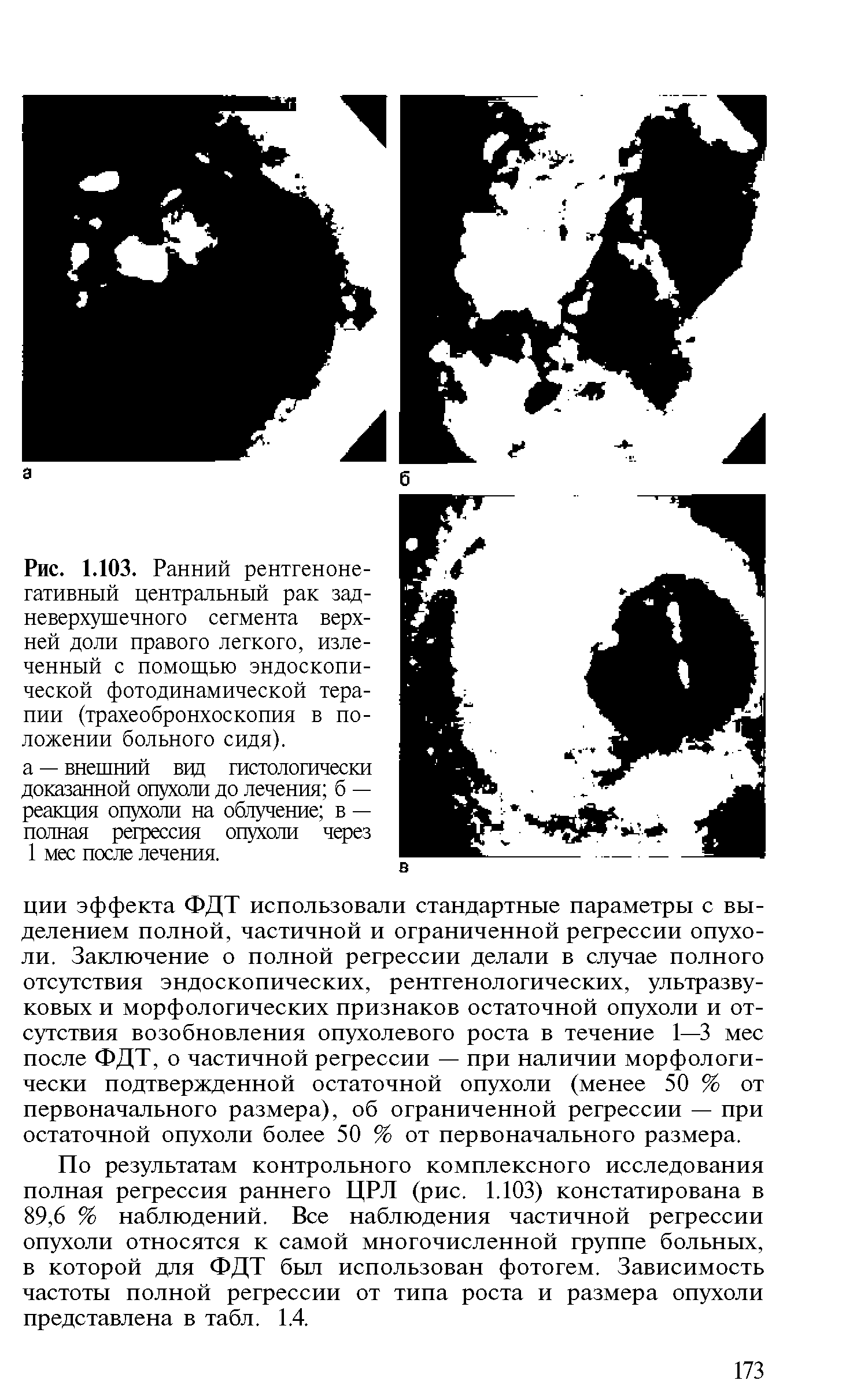 Рис. 1.103. Ранний рентгенонегативный центральный рак задневерхушечного сегмента верхней доли правого легкого, излеченный с помощью эндоскопической фотодинамической терапии (трахеобронхоскопия в положении больного сидя).