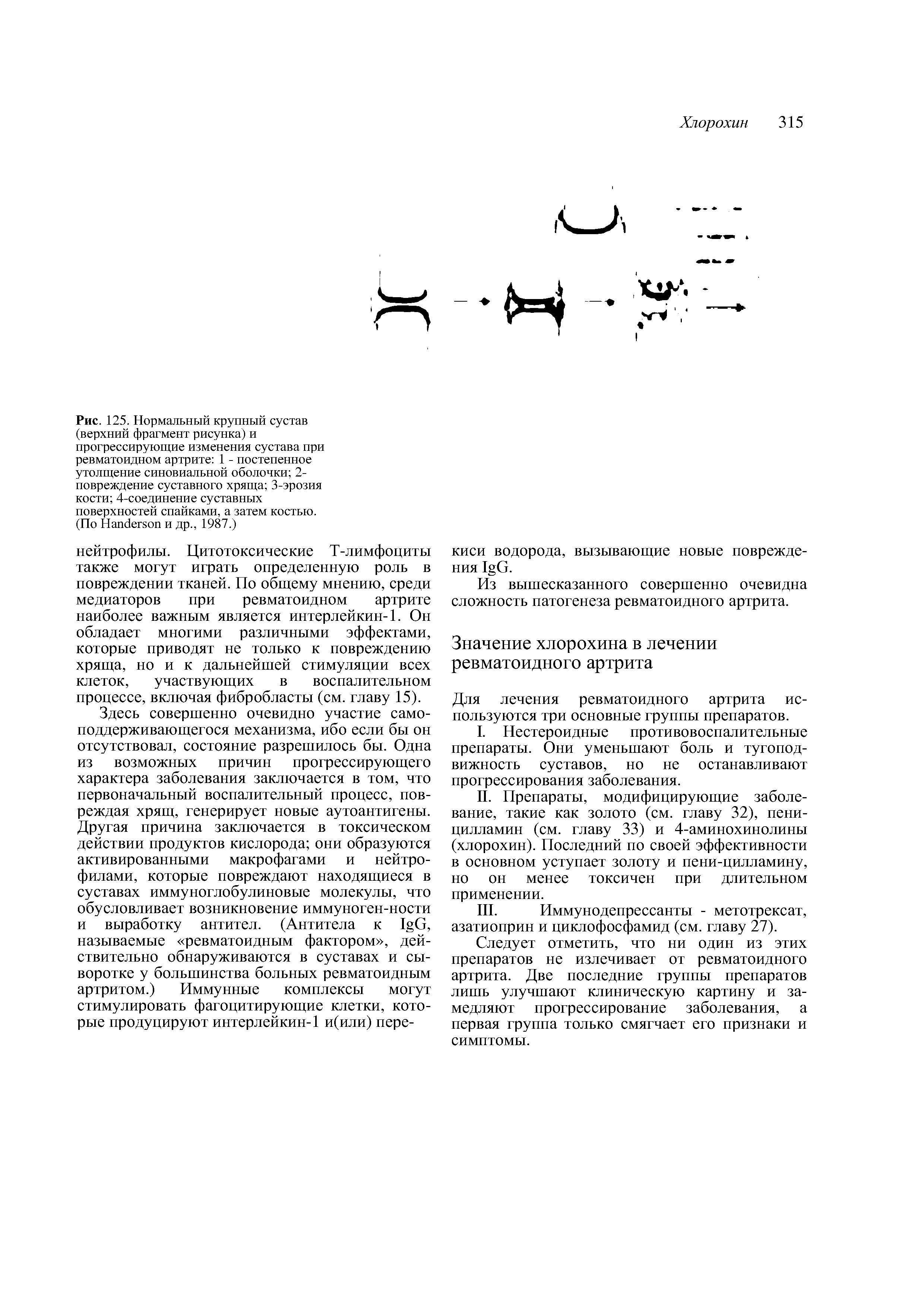 Рис. 125. Нормальный крупный сустав (верхний фрагмент рисунка) и прогрессирующие изменения сустава при ревматоидном артрите 1 - постепенное утолщение синовиальной оболочки 2-повреждение суставного хряща 3-эрозия кости 4-соединение суставных поверхностей спайками, а затем костью. (По H и др., 1987.)...