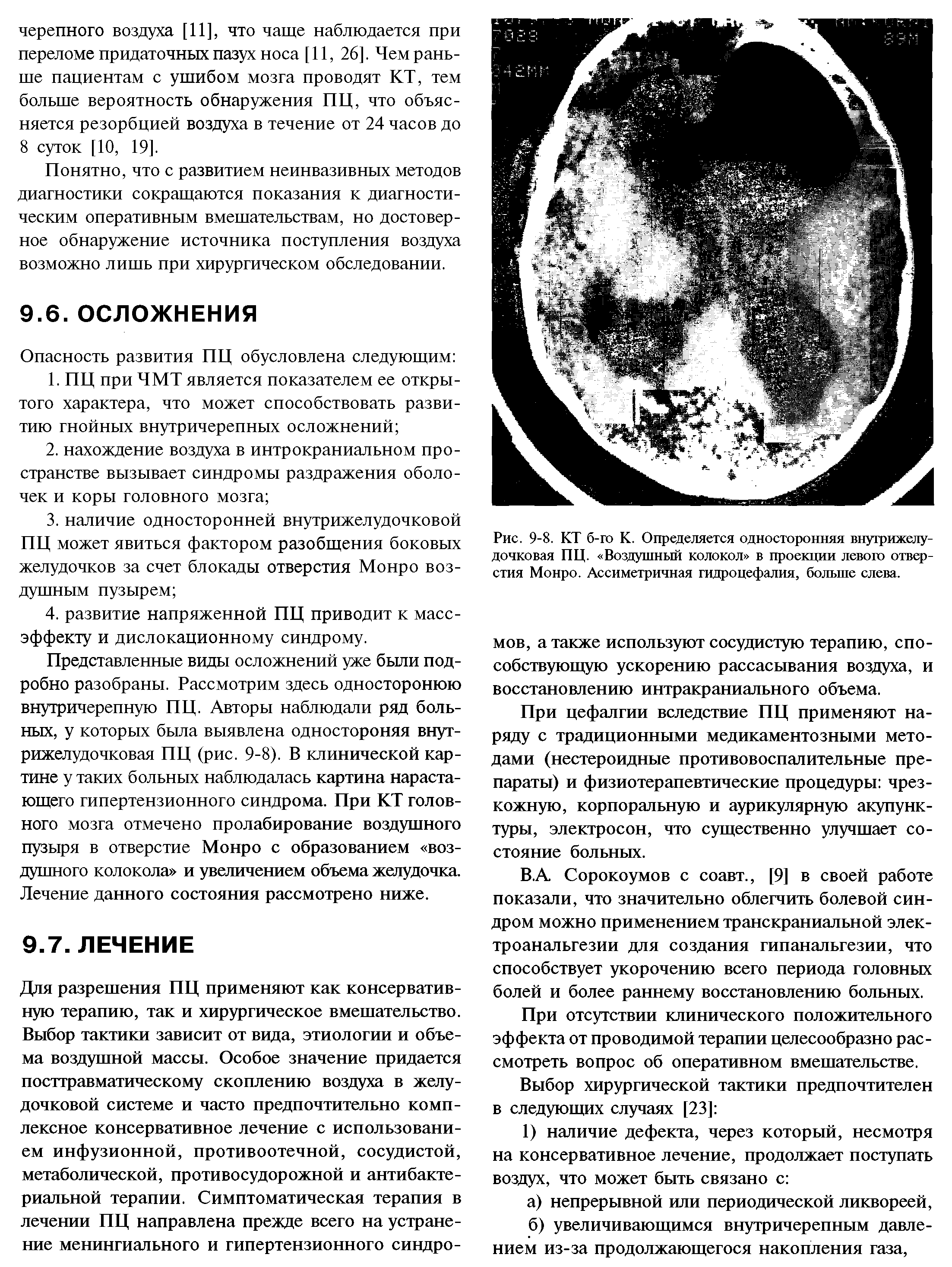 Рис. 9-8. КТ б-го К. Определяется односторонняя внутрижелудочковая ПЦ. Воздушный колокол в проекции левого отверстия Монро. Ассиметричная гидроцефалия, больше слева.