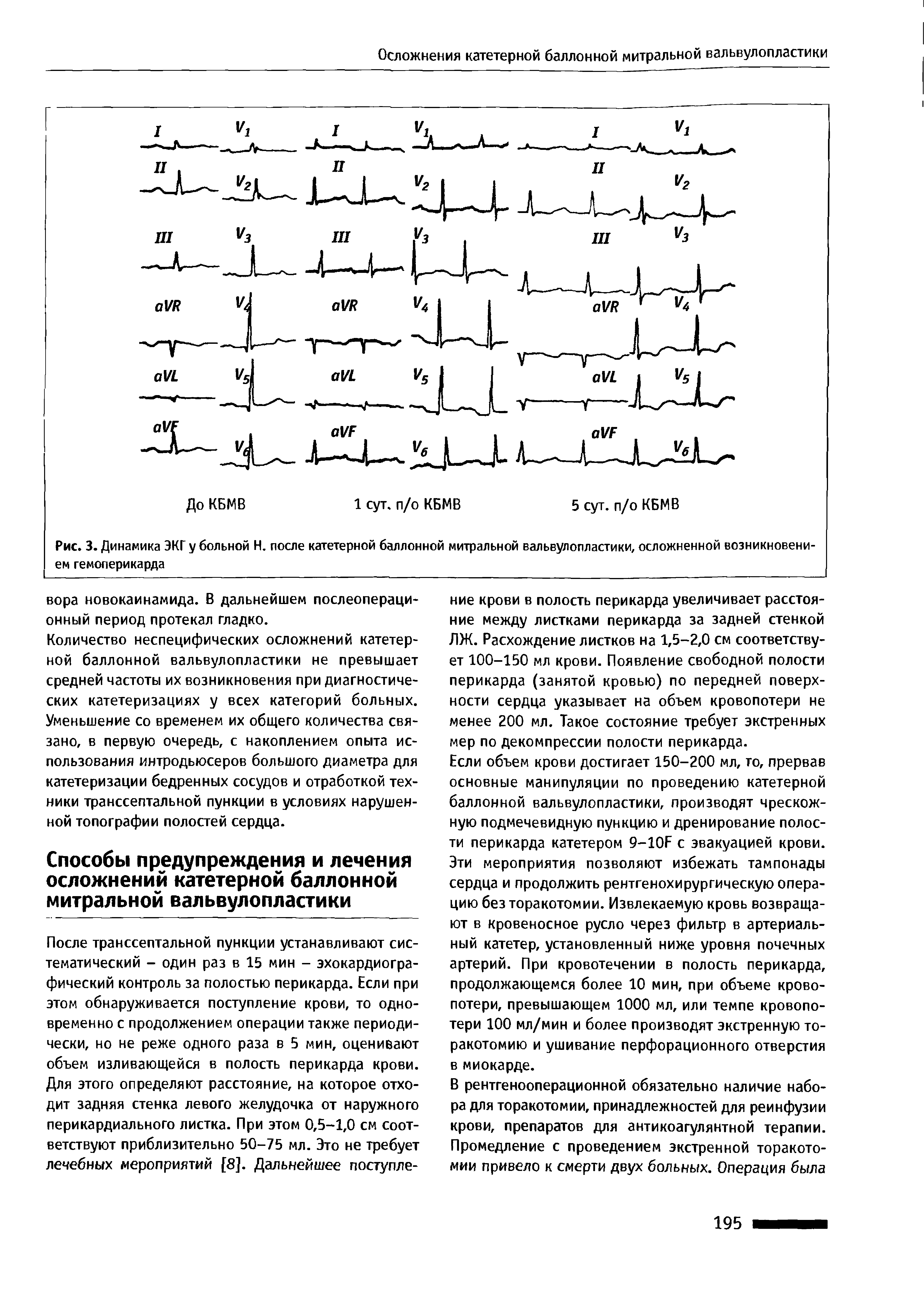 Рис. 3. Динамика ЭКГ у больной Н. после катетерной баллонной митральной вальвулопластики, осложненной возникновением гемоперикарда...