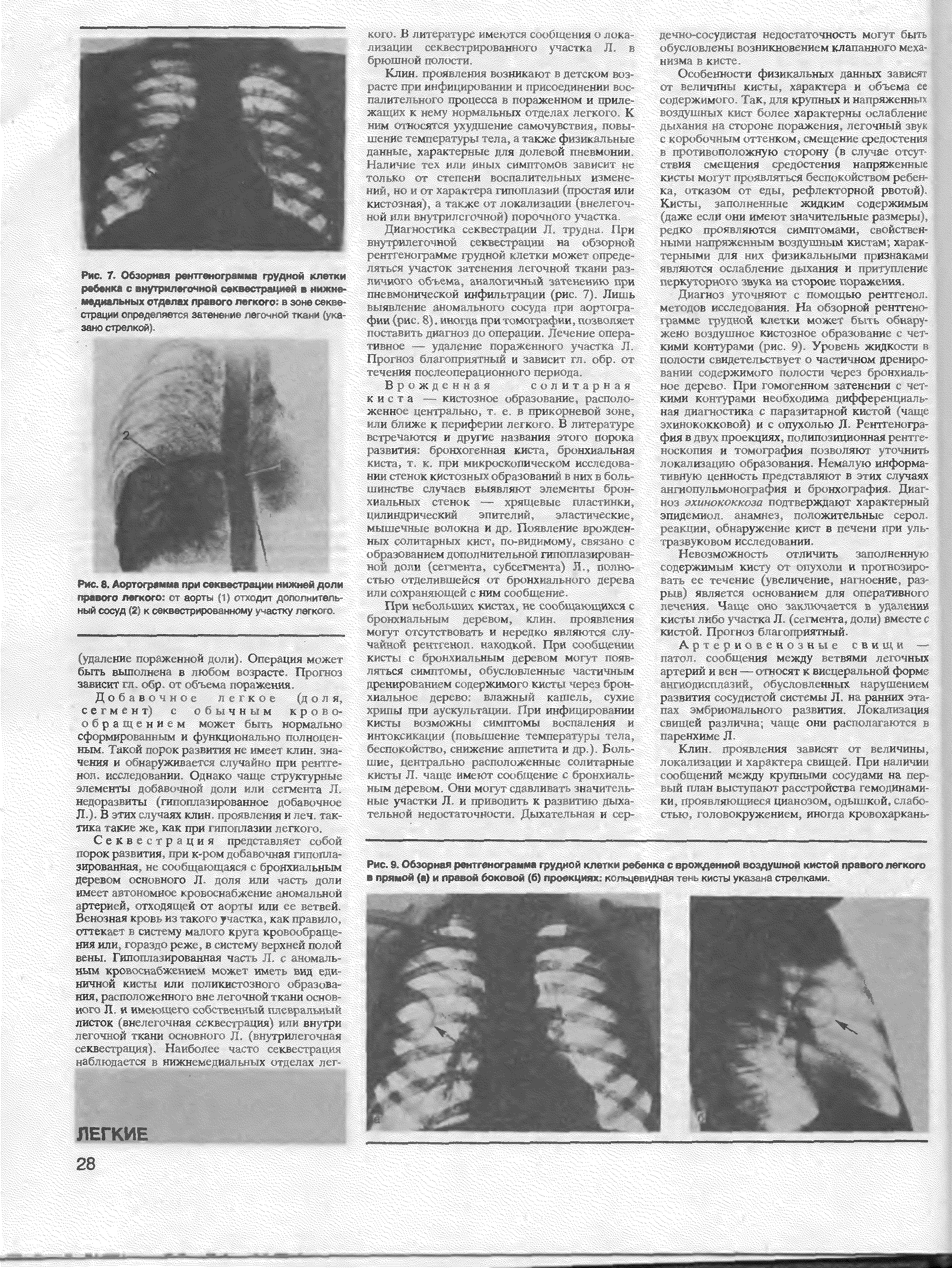 Рис. 7. Обжриия рвнтгвиограииа грудной клетки ребенка с нугрмпегочиой вквестрацюва иижнв- медиальных отделах правого легкого в зоне секвестрации определяет за ж- лв. лстст пст ст > -а за стрелкой .