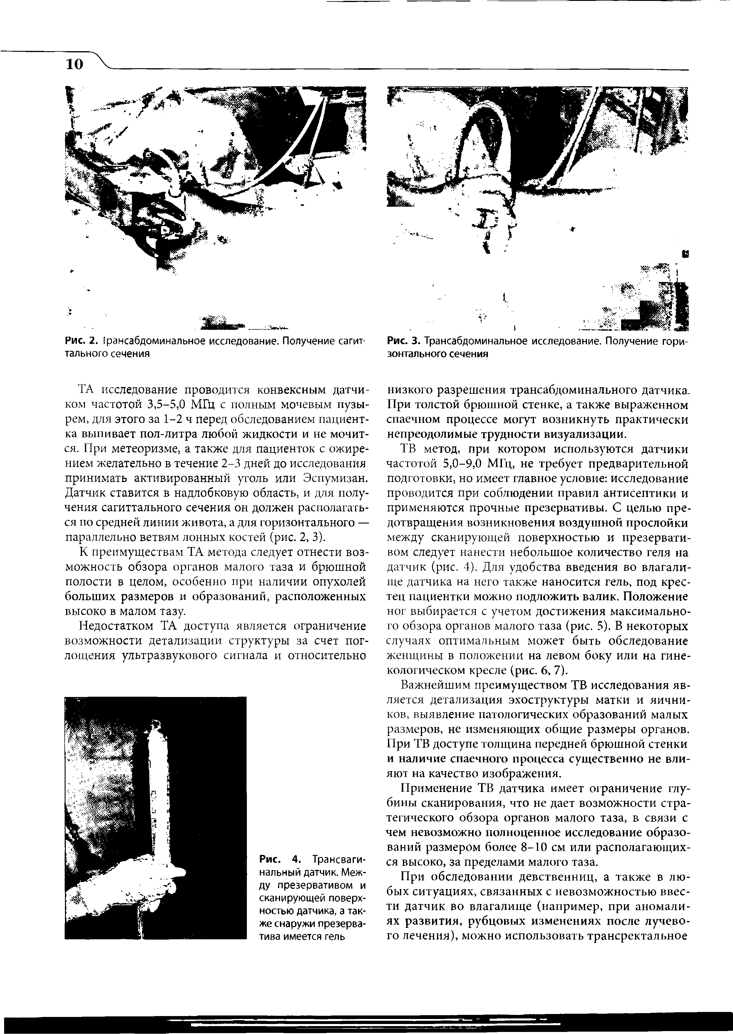 Рис. 4. Трансвагинальный датчик. Между презервативом и сканирующей поверхностью датчика, а также снаружи презерватива имеется гель...