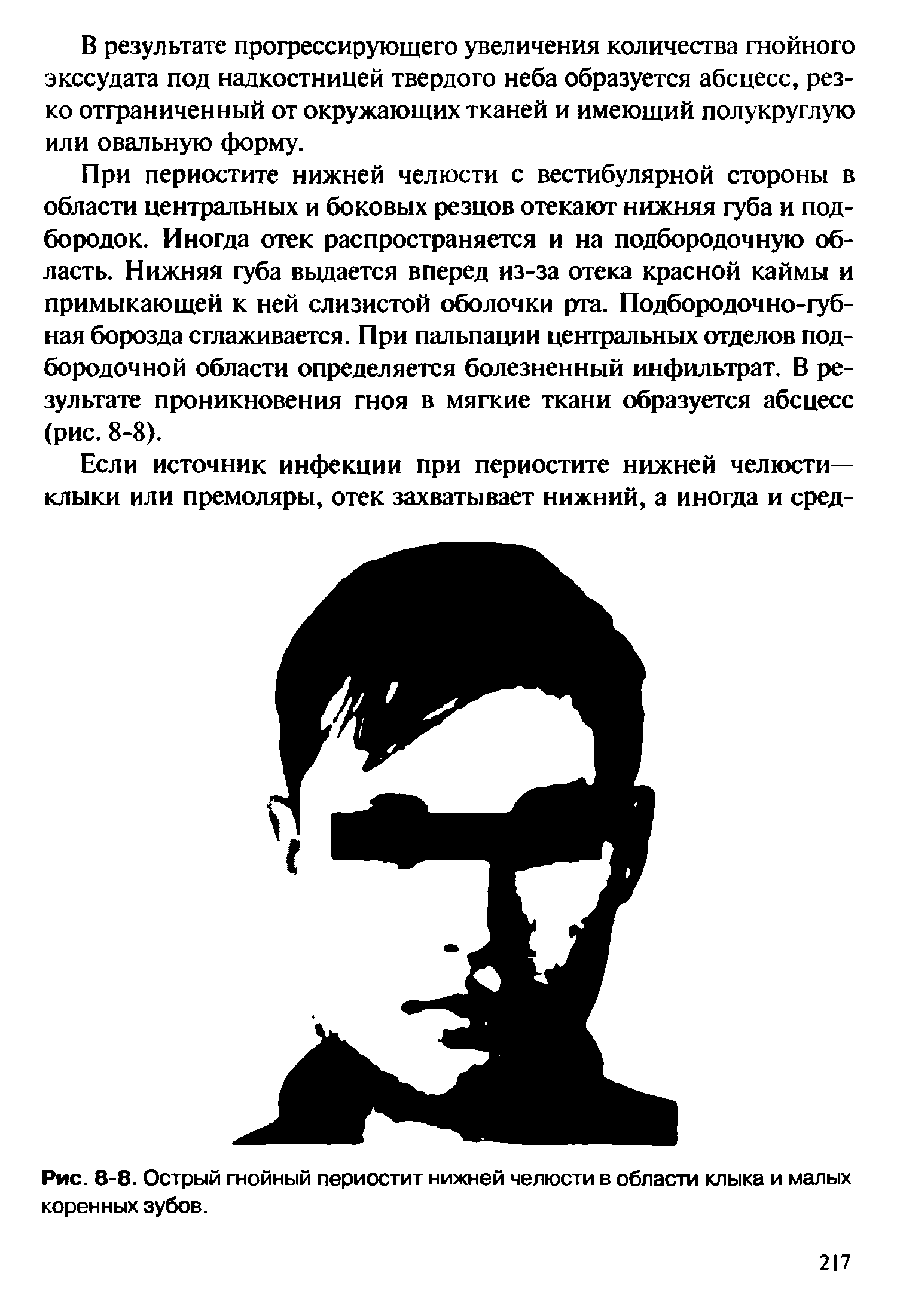 Рис. 8-8. Острый гнойный периостит нижней челюсти в области клыка и малых коренных зубов.