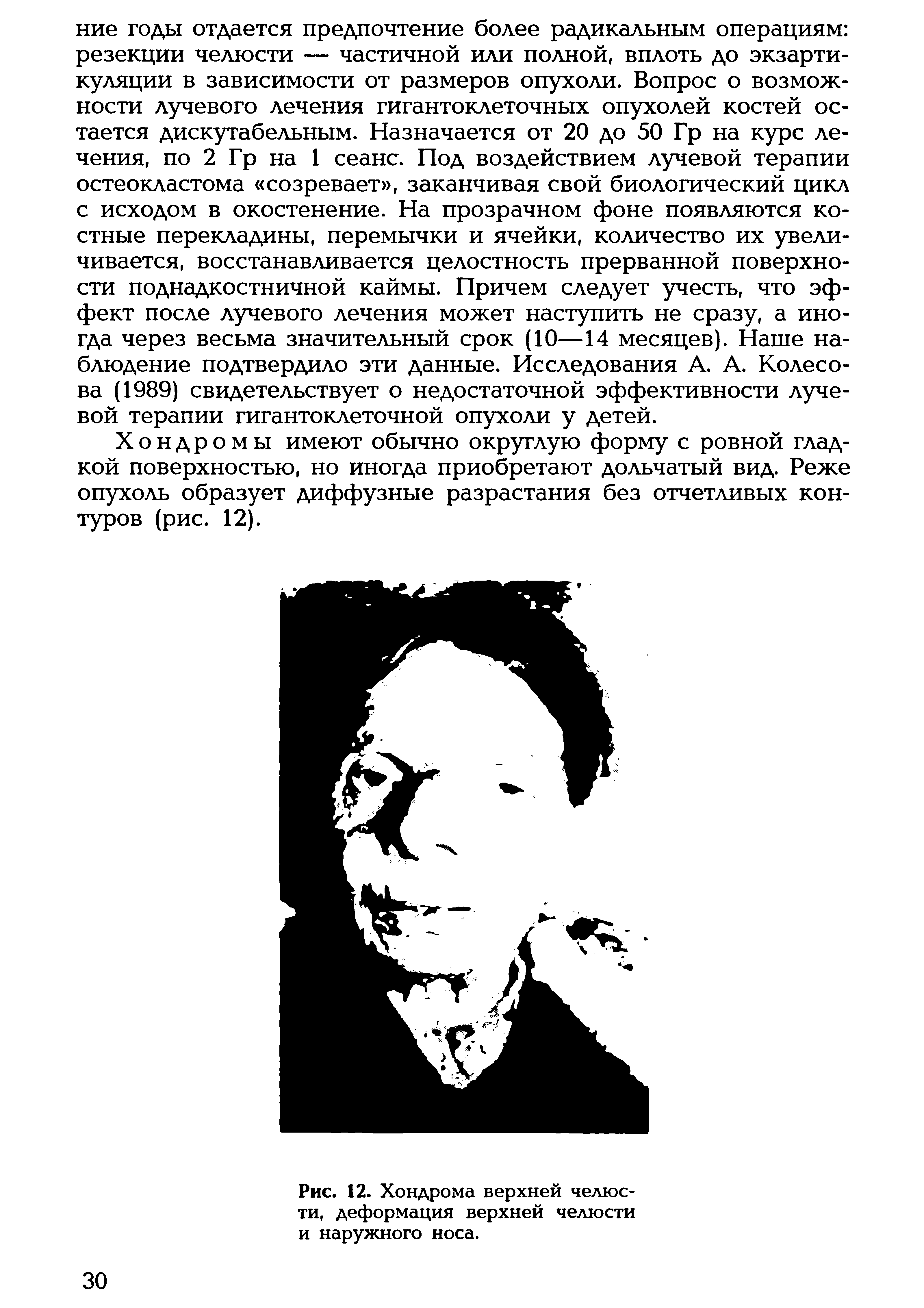 Рис. 12. Хондрома верхней челюсти, деформация верхней челюсти и наружного носа.