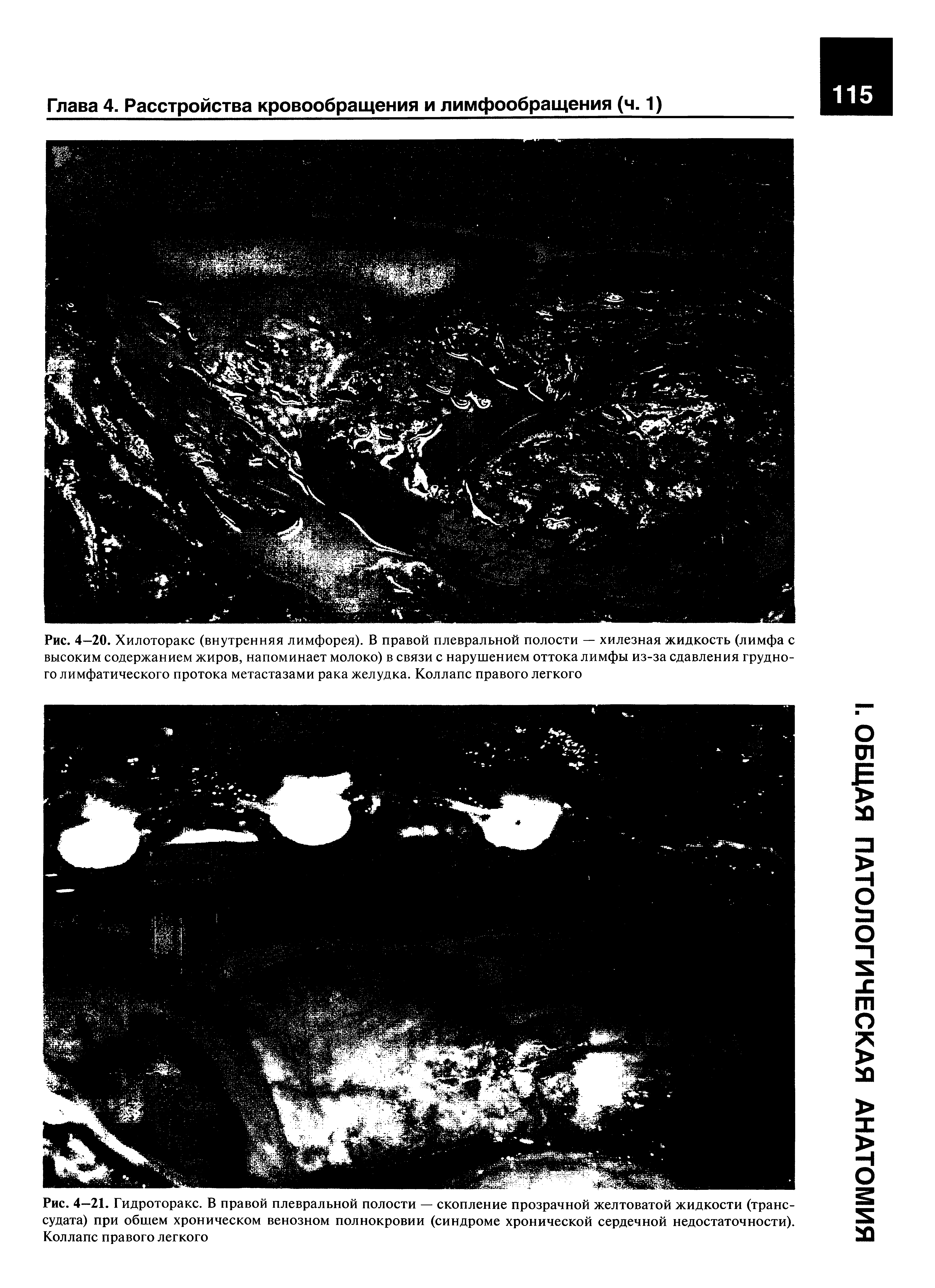 Рис. 4—20. Хилоторакс (внутренняя лимфорея). В правой плевральной полости — хилезная жидкость (лимфа с высоким содержанием жиров, напоминает молоко) в связи с нарушением оттока лимфы из-за сдавления грудного лимфатического протока метастазами рака желудка. Коллапс правого легкого...