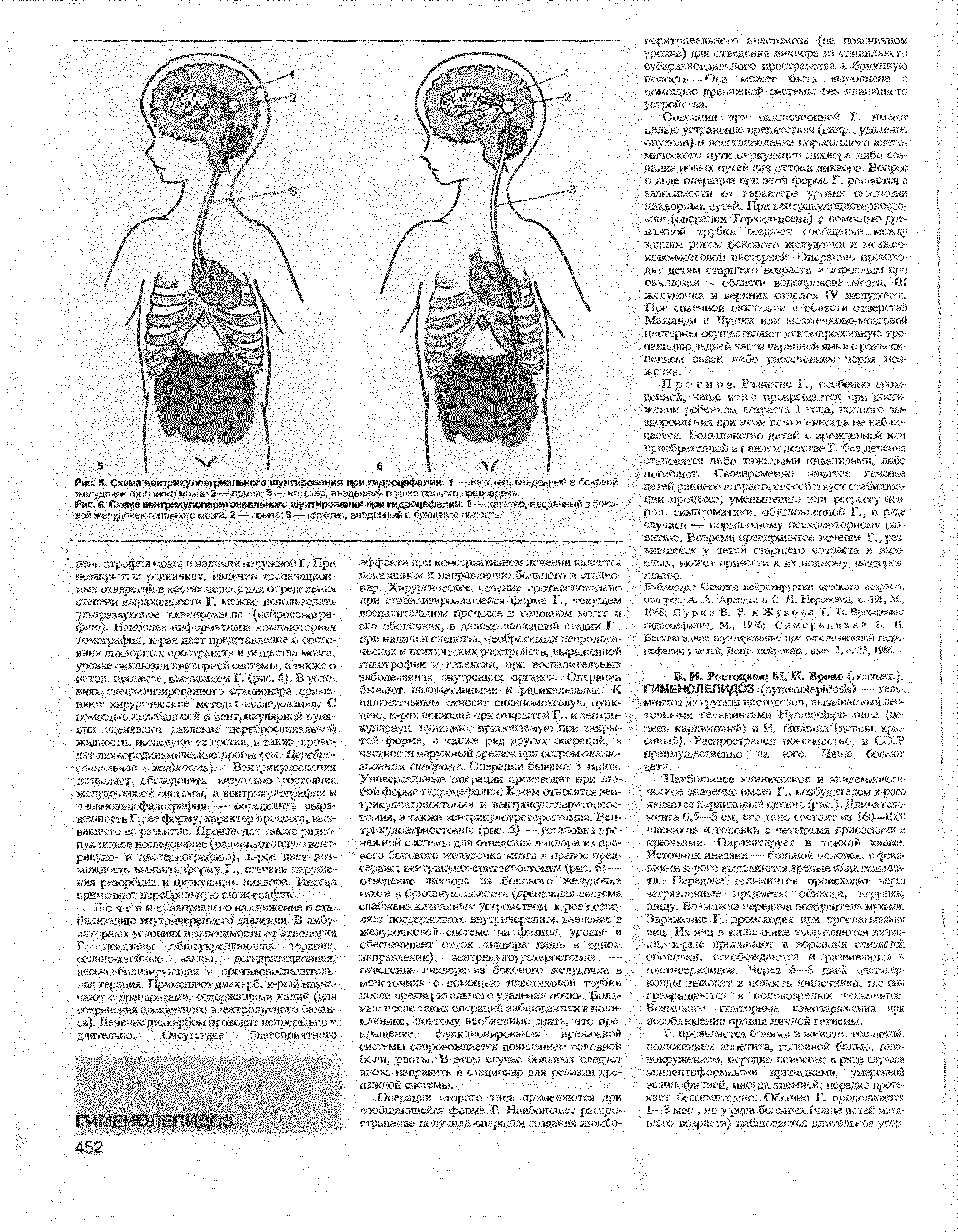 Рис. 6. Схеме вентрикулоперитонеального шунтирования при гидроцефалии 1 —- катетер, введенным в жо- и и рем гою иго 2— >гм<а 3— / к. 1во еьед ь брюилд- ...