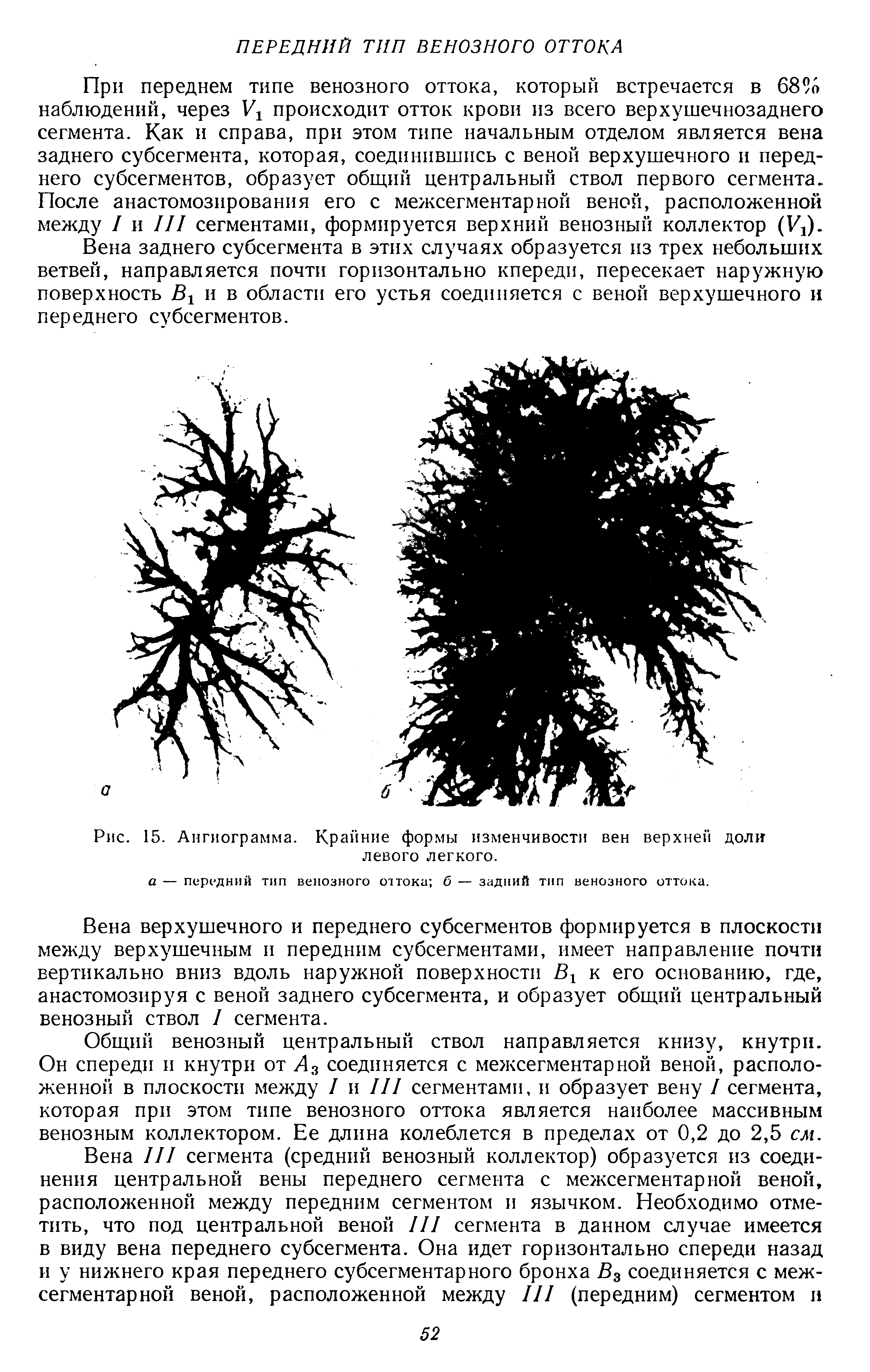 Рис. 15. Ангиограмма. Крайние формы изменчивости вен верхней доли левого легкого.