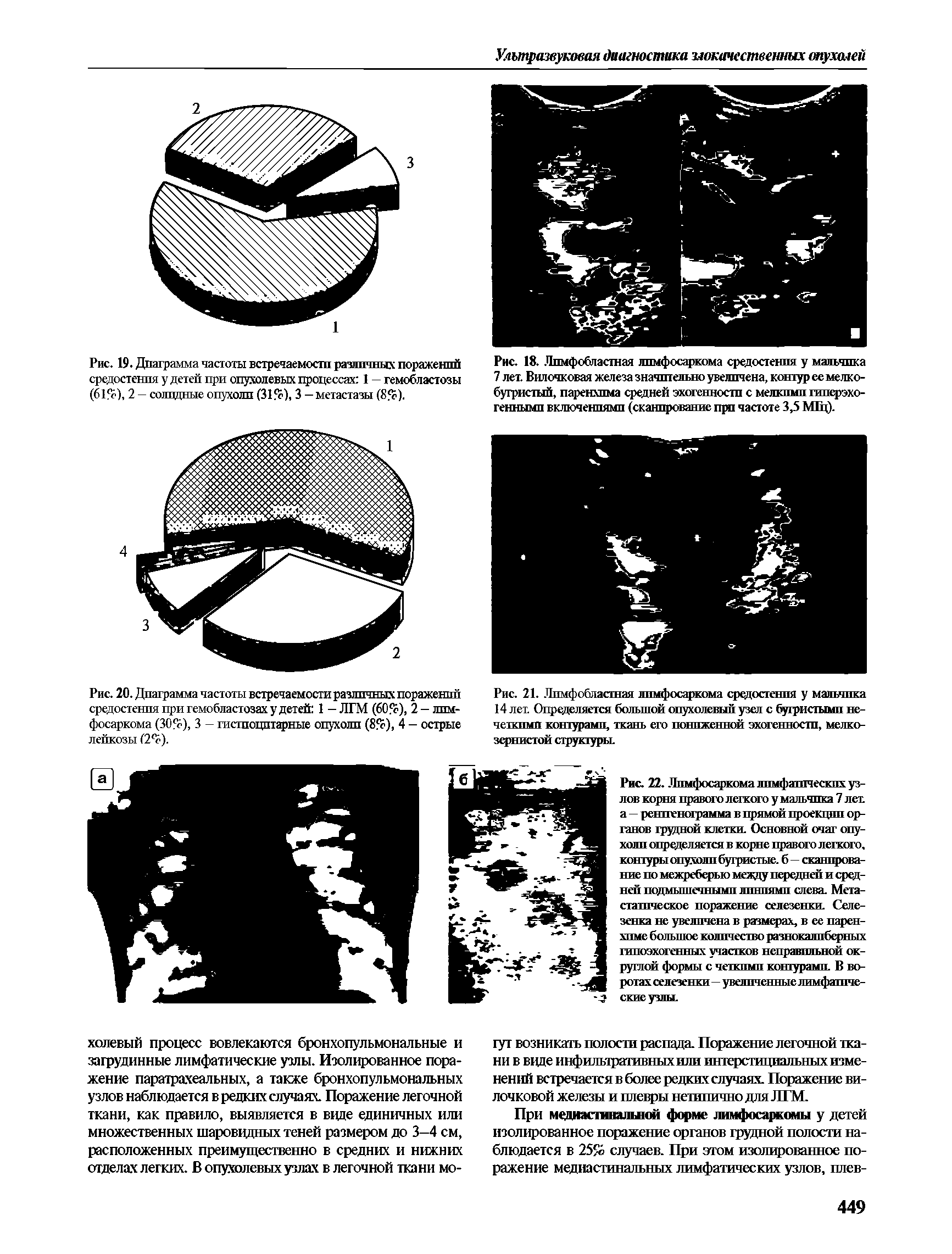 Рис. 20. Диаграмма частоты встречаемости различных поражений средостения при гемобластозах у детей 1 — ЛГМ (6О5е), 2 —лпм-фосаркома (30 ), 3 - гистпоцптарные опухоли (8 ), 4 - острые лейкозы (2°с).