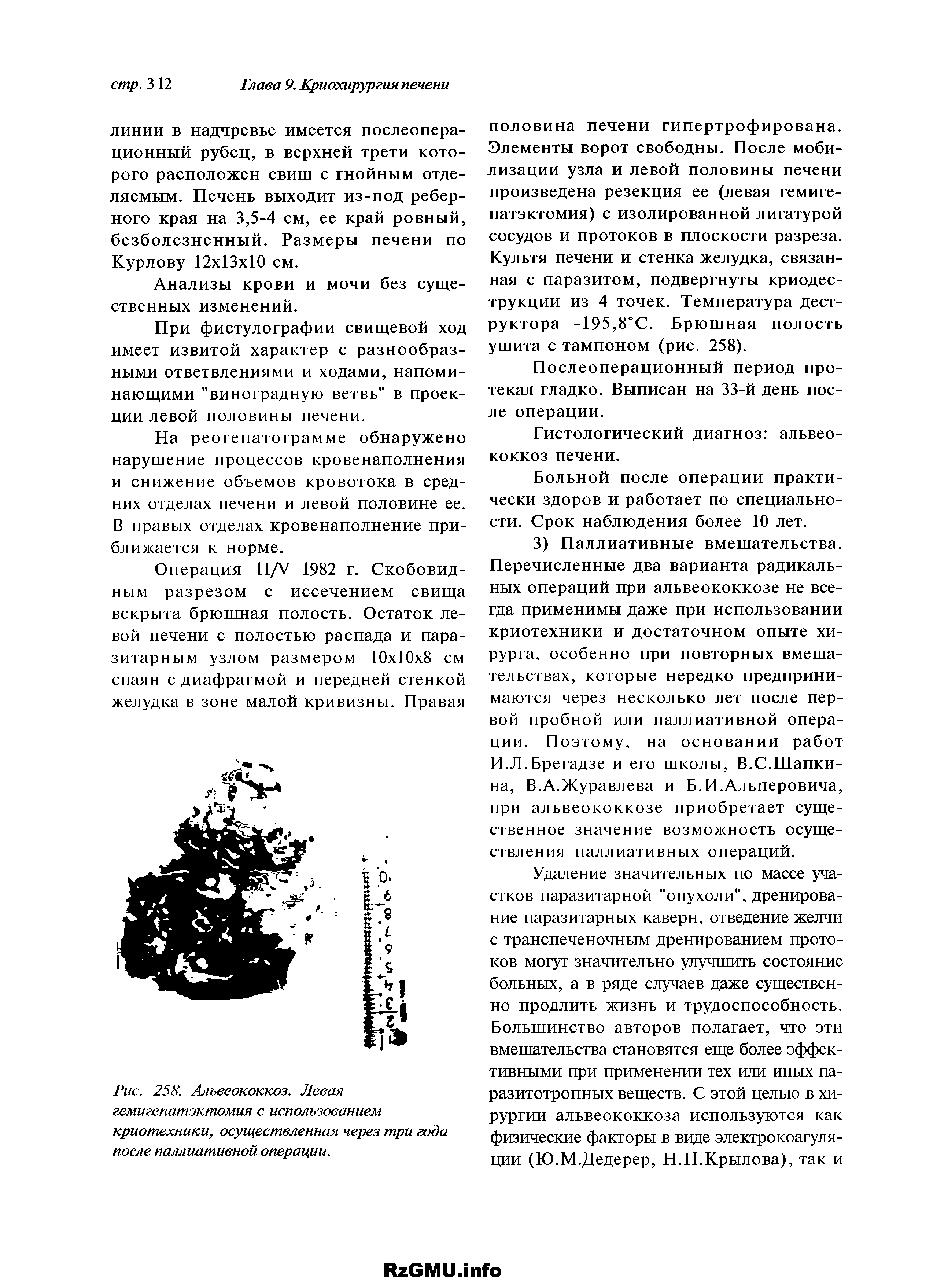 Рис. 258. Альвеококкоз. Левая гемигепатэктомия с использованием криотехники, осуществленная через три года после паллиативной операции.