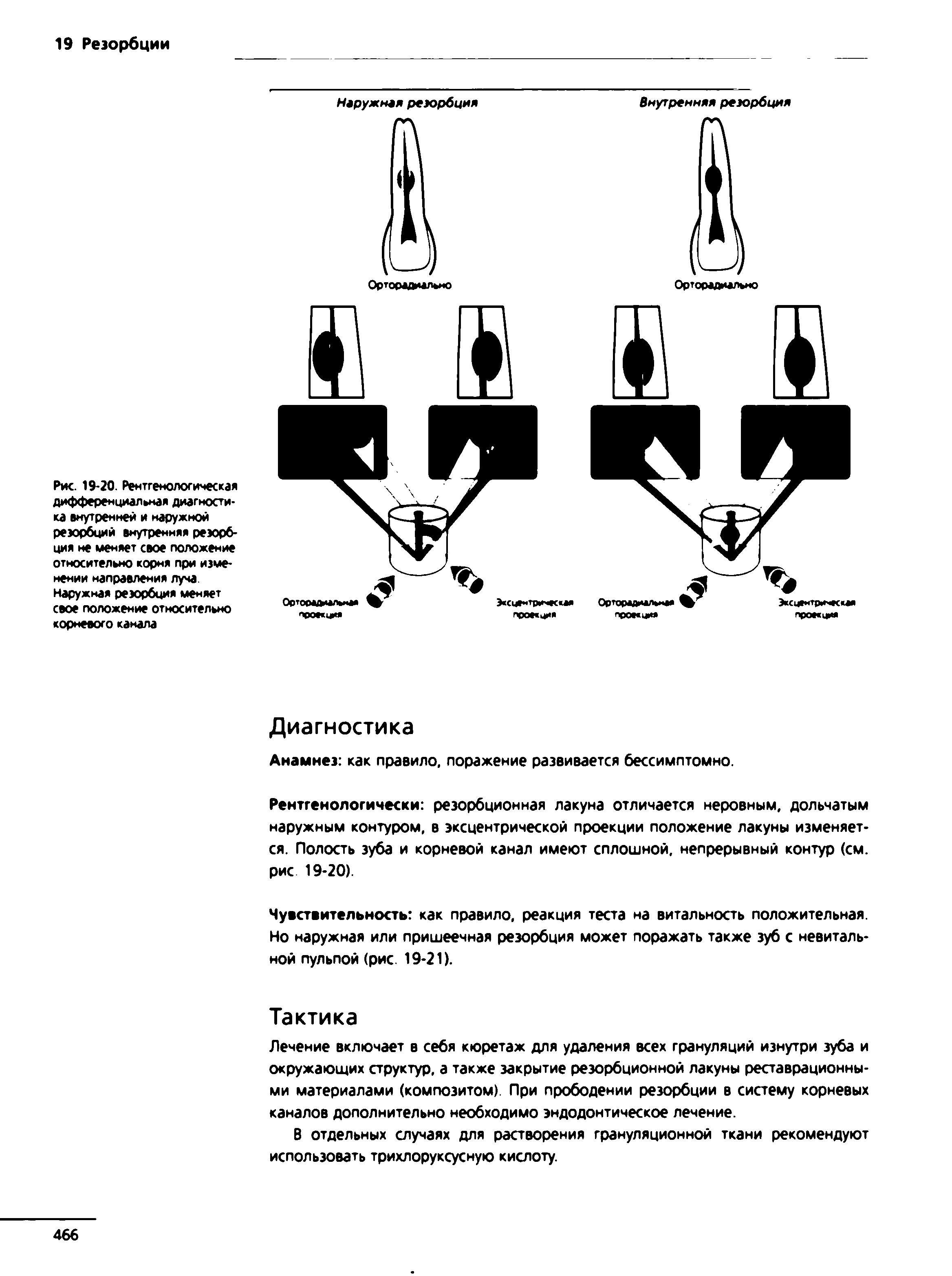 Рис. 19-20. Рентгенологическая дифференциальная диагностика внутренней и наружной резорбций внутренняя резорбция не меняет свое положение относительно корня при изменении направления луча. Наружная резорбция меняет свое положение относительно корневого канала...