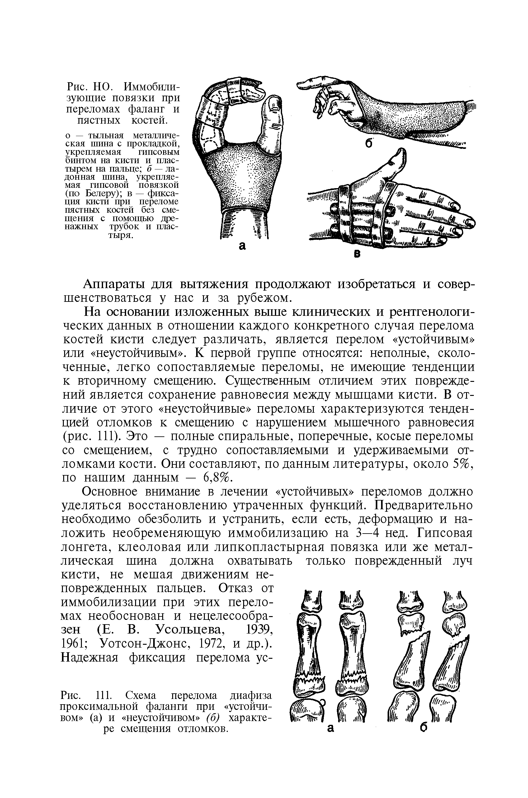 Рис. 111. Схема перелома диафиза проксимальной фаланги при устойчивом (а) и неустойчивом (б) характере смещения отломков.