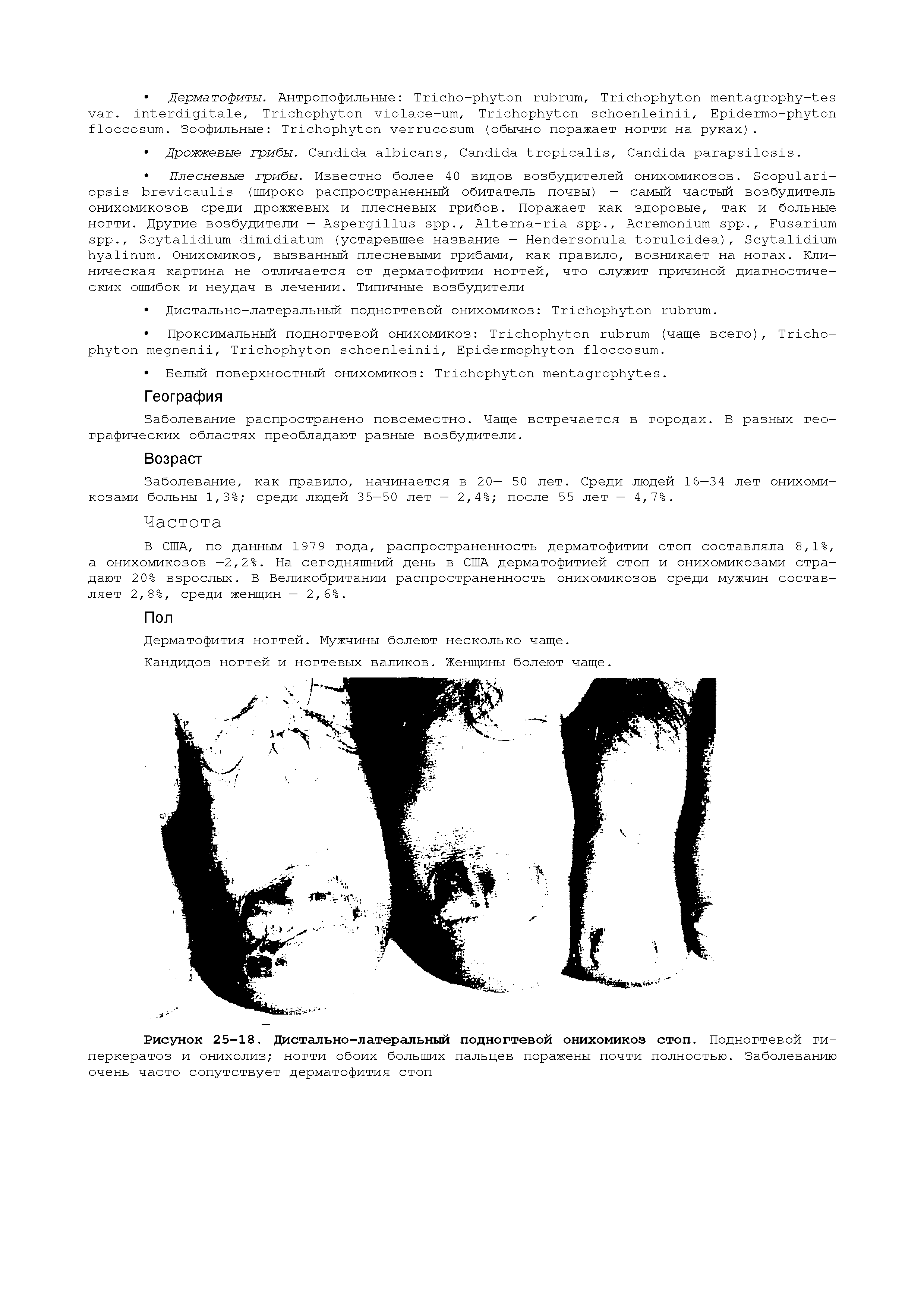 Рисунок 25-18. Дистально-латеральный подногтевой онихомикоз стоп. Подногтевой гиперкератоз и онихолиз ногти обоих больших пальцев поражены почти полностью. Заболеванию очень часто сопутствует дерматофития стоп...