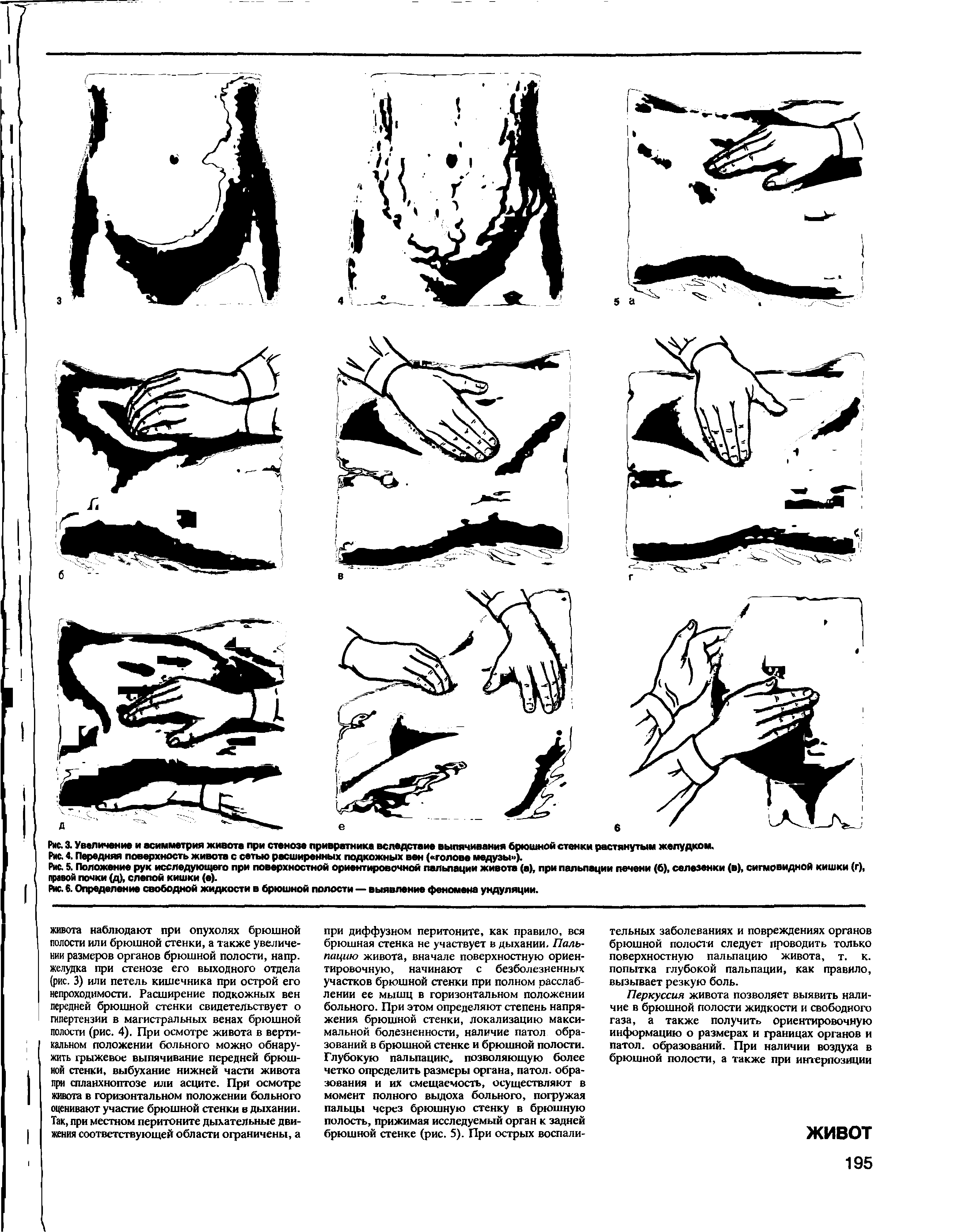 Рис. 4. Передняя поверхность живота с сетью расширенных подкожных вен ( голове медузы ).