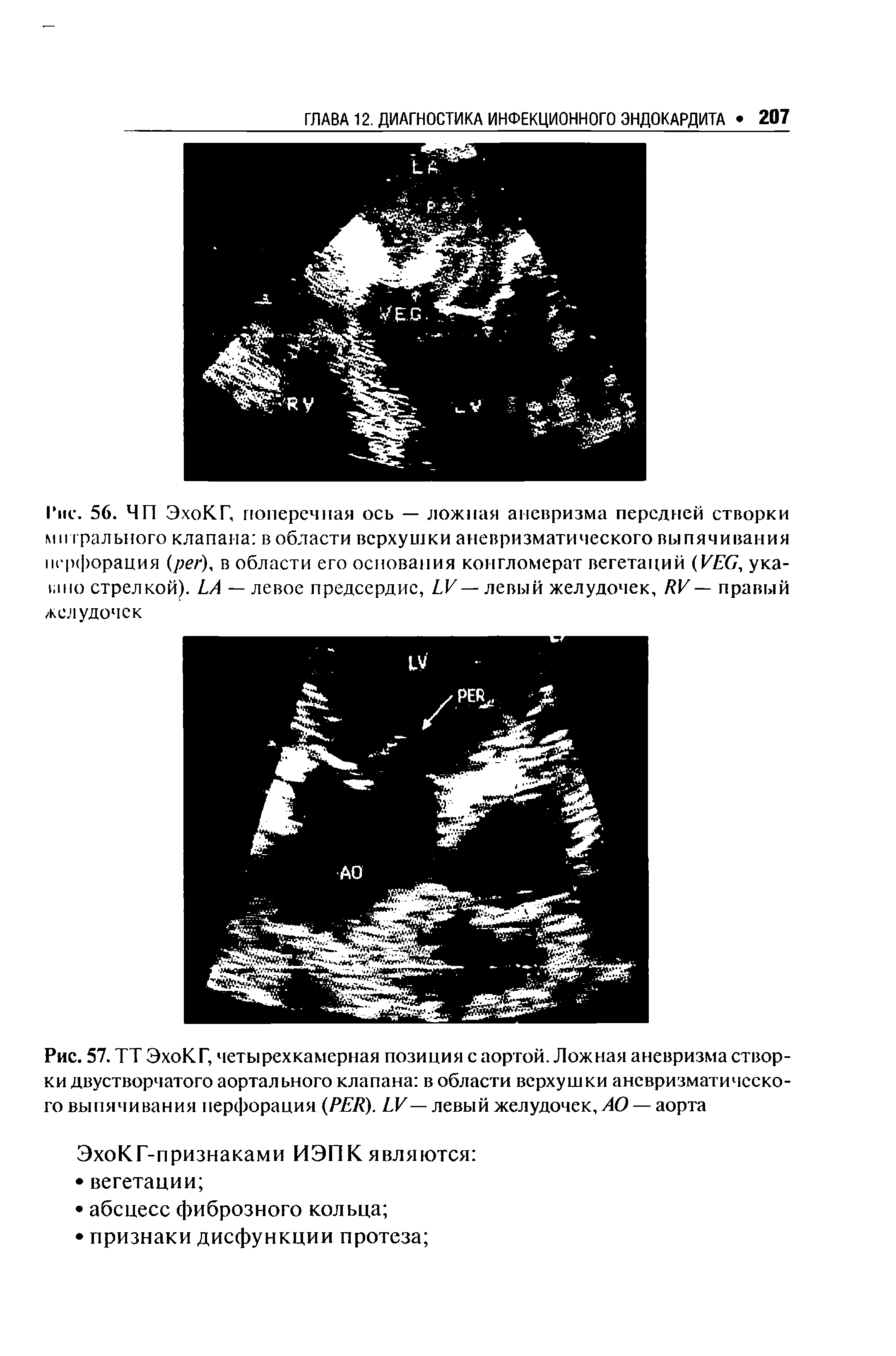 Рис. 57. ТТ ЭхоКГ, четырехкамерная позиция с аортой. Ложная аневризма створки двустворчатого аортального клапана в области верхушки аневризматического выпячивания перфорация (PER). LV — левый желудочек, АО — аорта...