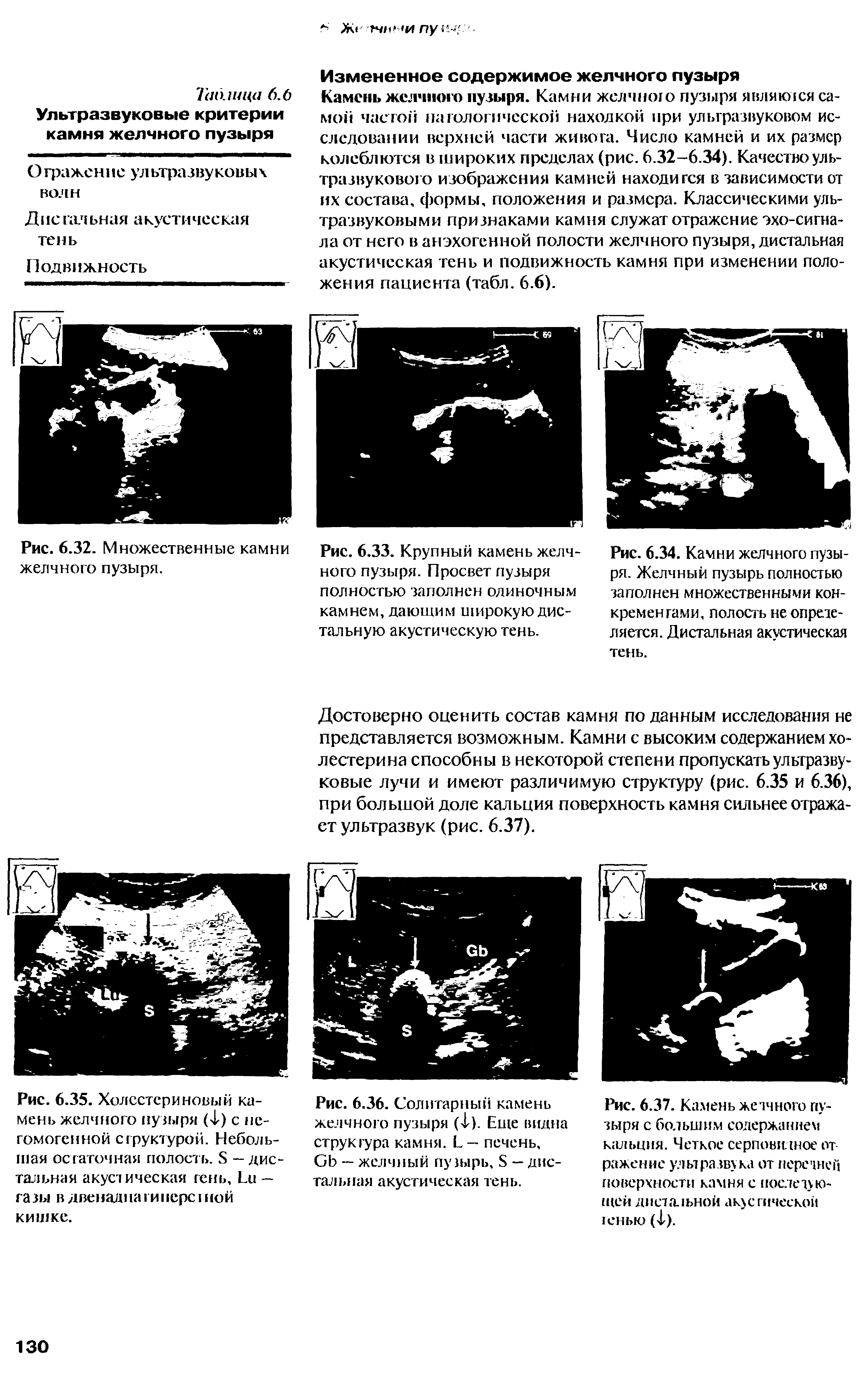 Рис. 6.34. Камни желчного пузыря. Желчный пузырь полностью заполнен множественными кон-...