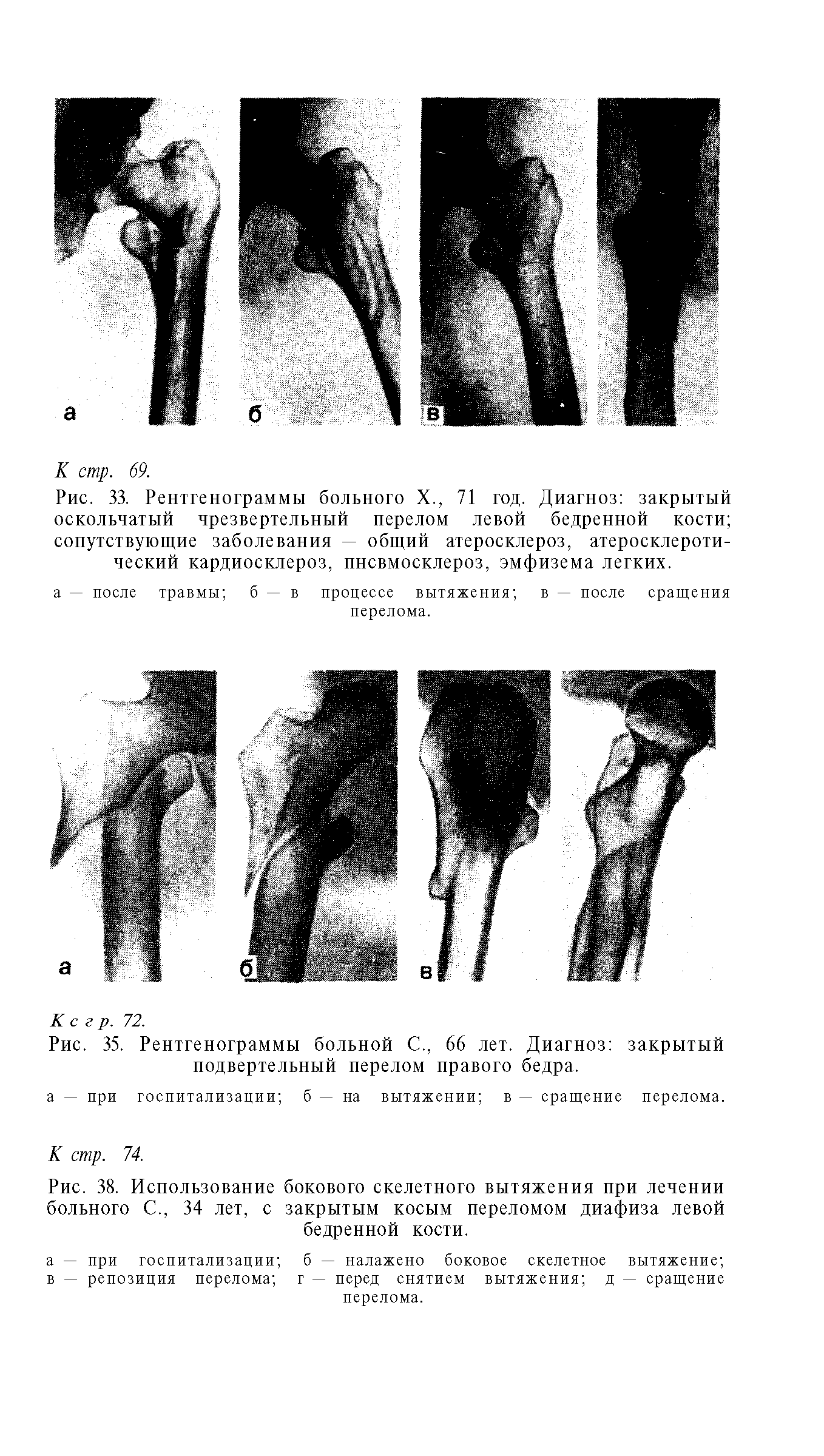 Рис. 35. Рентгенограммы больной С., 66 лет. Диагноз подвертельный перелом правого бедра.
