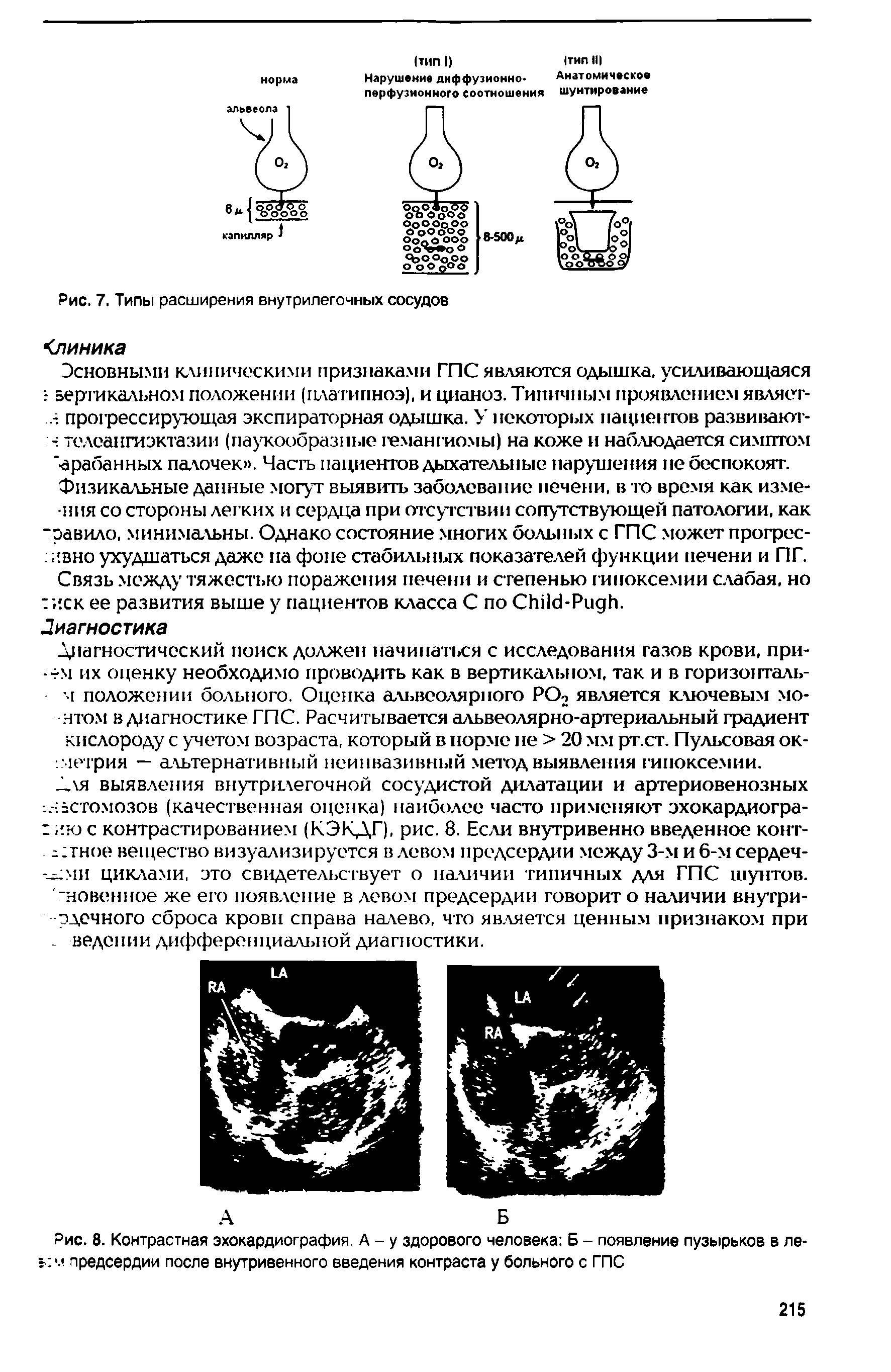 Рис. 8. Контрастная эхокардиография. А - у здорового человека Б - появление пузырьков в ле-I м предсердии после внутривенного введения контраста у больного с ГПС...