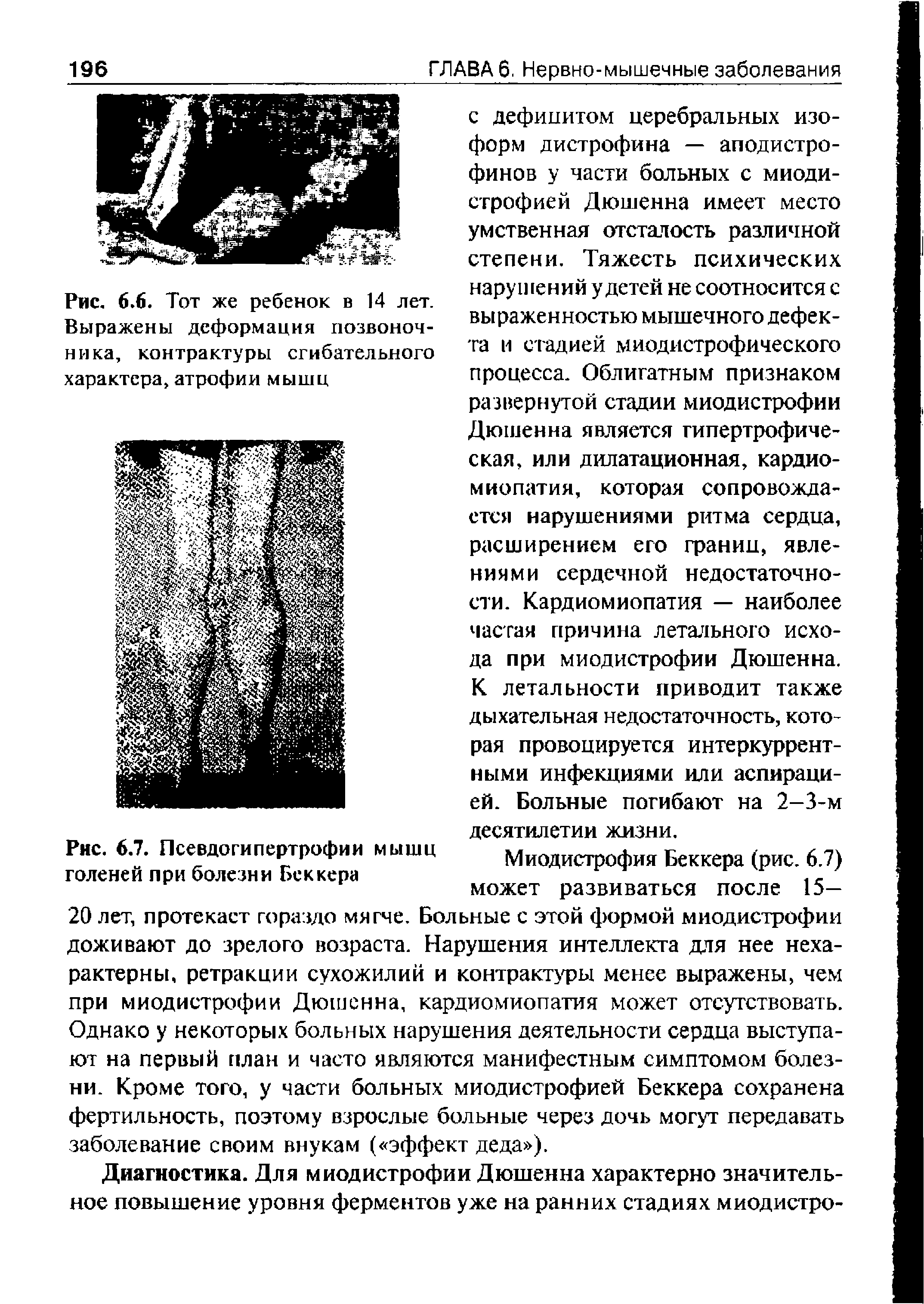 Рис. 6.7. Псевдогипертрофии мышц Миодистрофия Беккера (рис. 6.7) голеней при болезни Беккера. г...