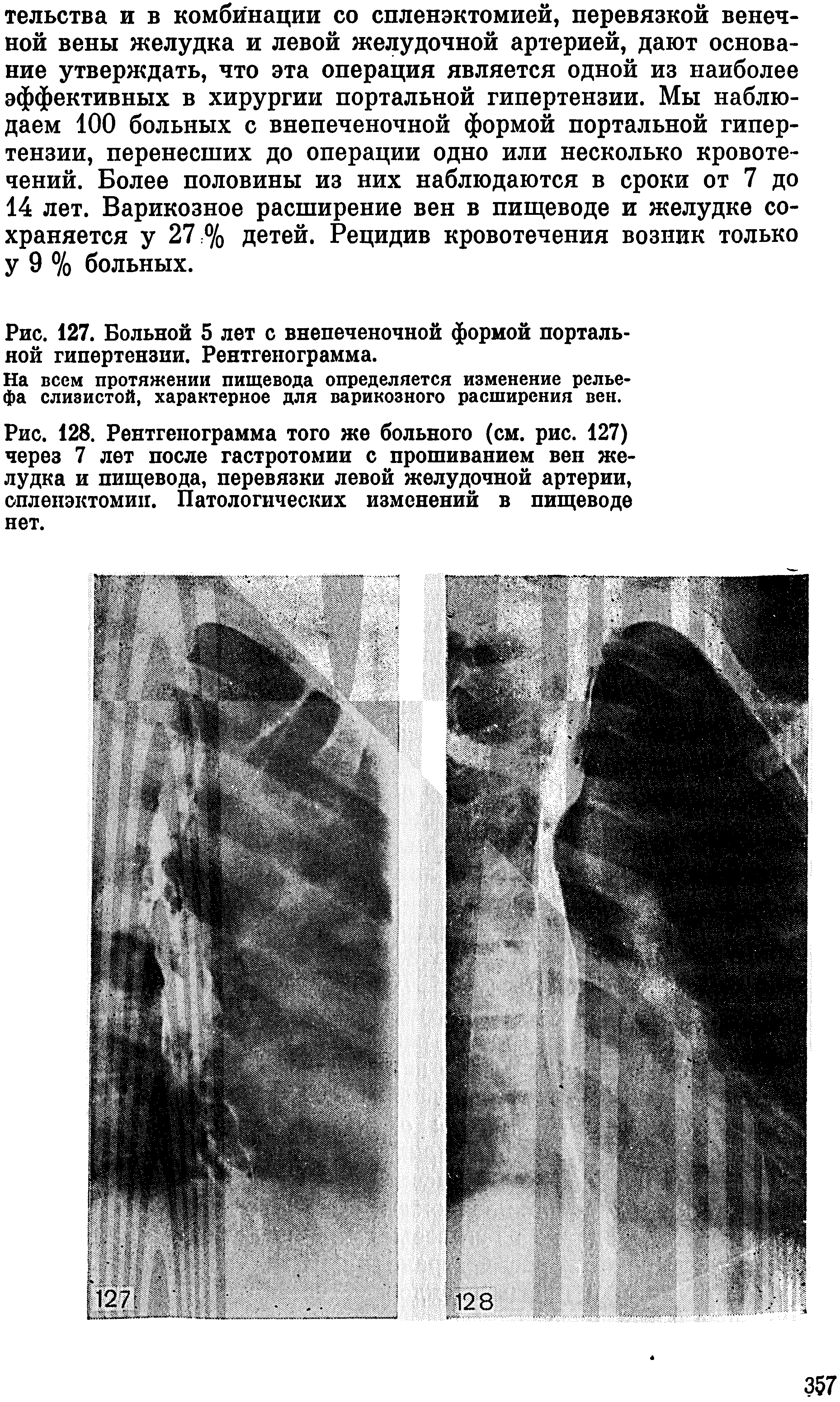 Рис. 127. Больной 5 лет с внепеченочной формой портальной гипертензии. Рентгенограмма.