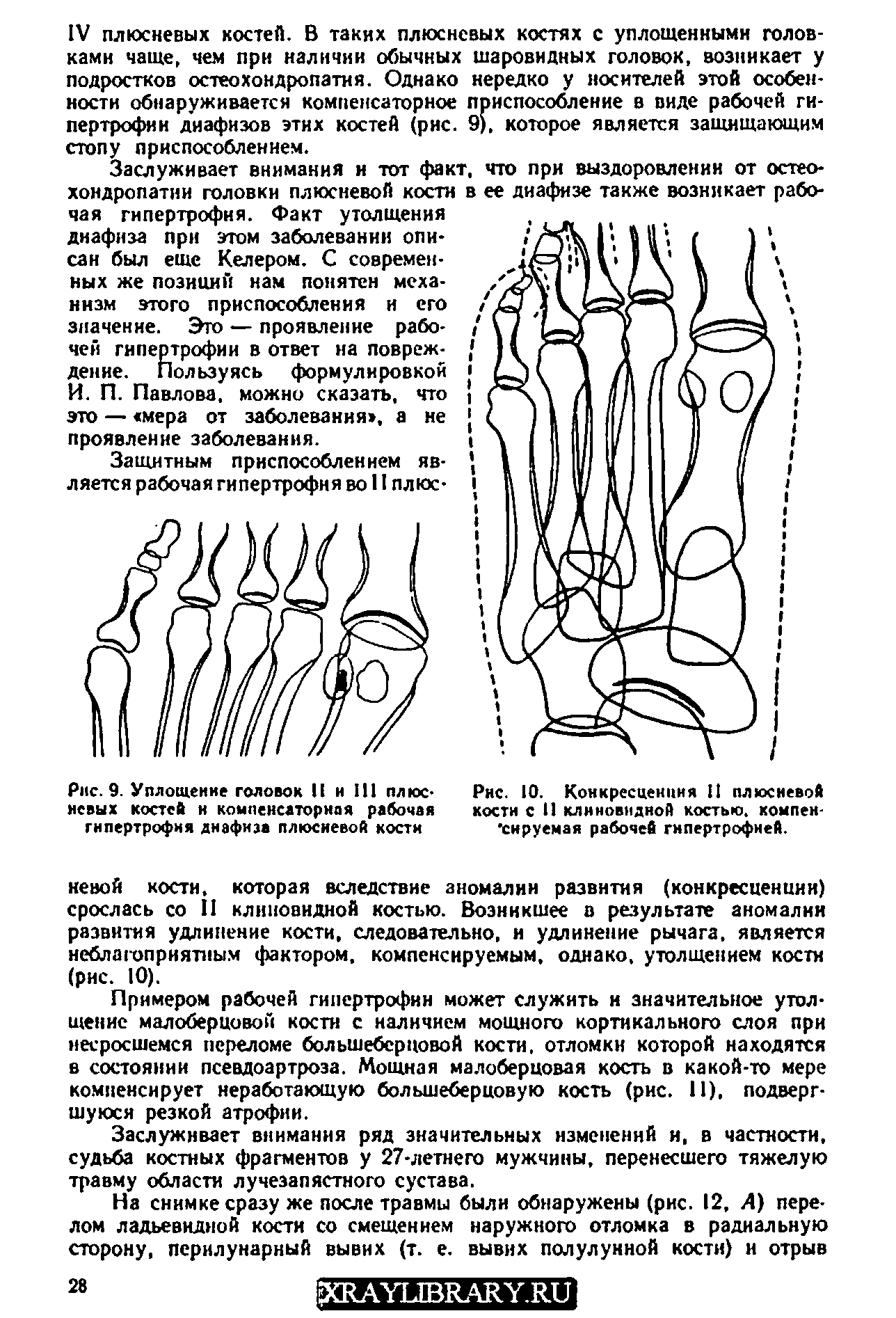 Рис. 9. Уплощение головок II н III плюсневых костей и компенсаторная рабочая гипертрофия диафиза плюсневой кости...