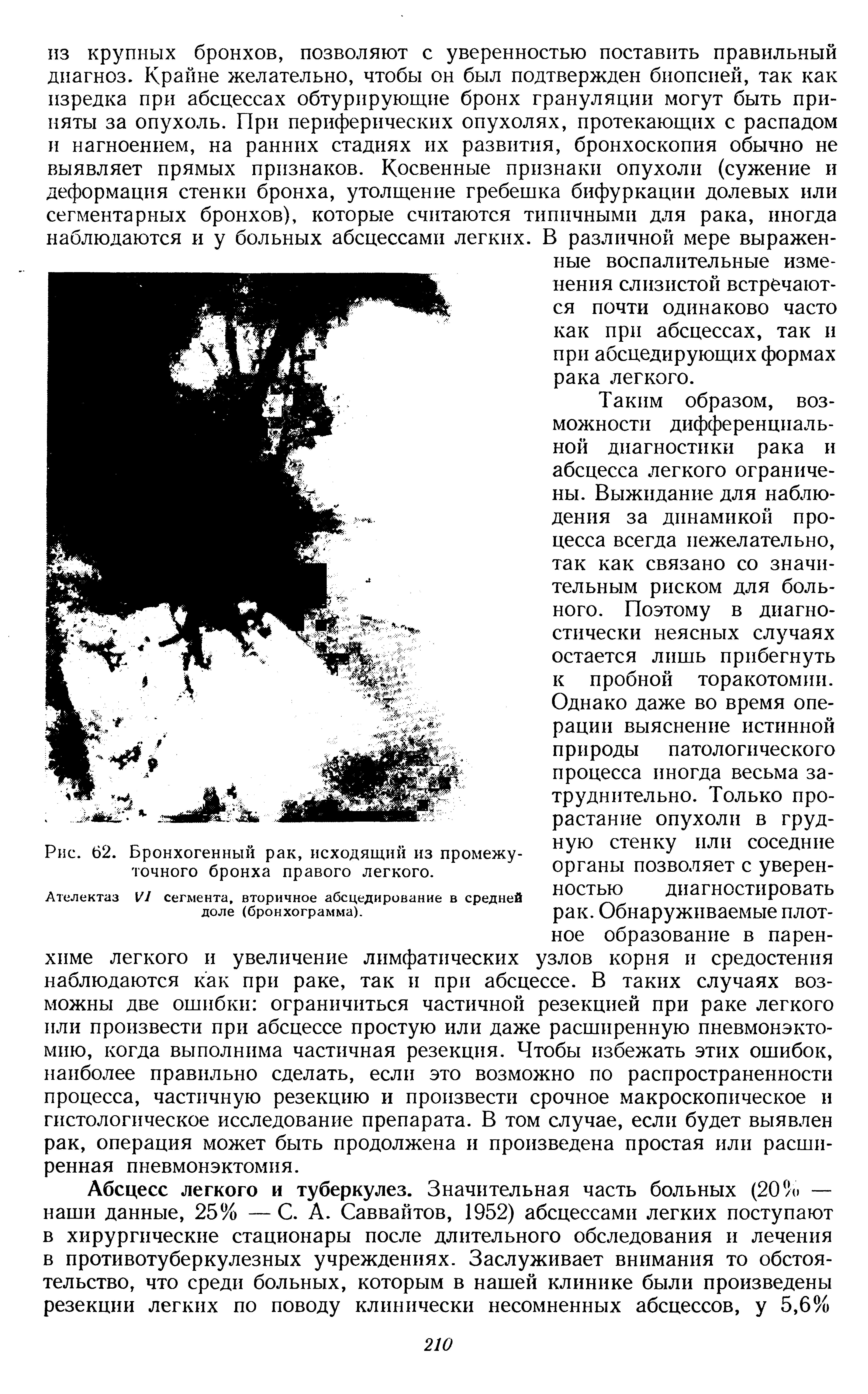 Рис. 62. Бронхогенный рак, исходящий из промежуточного бронха правого легкого.