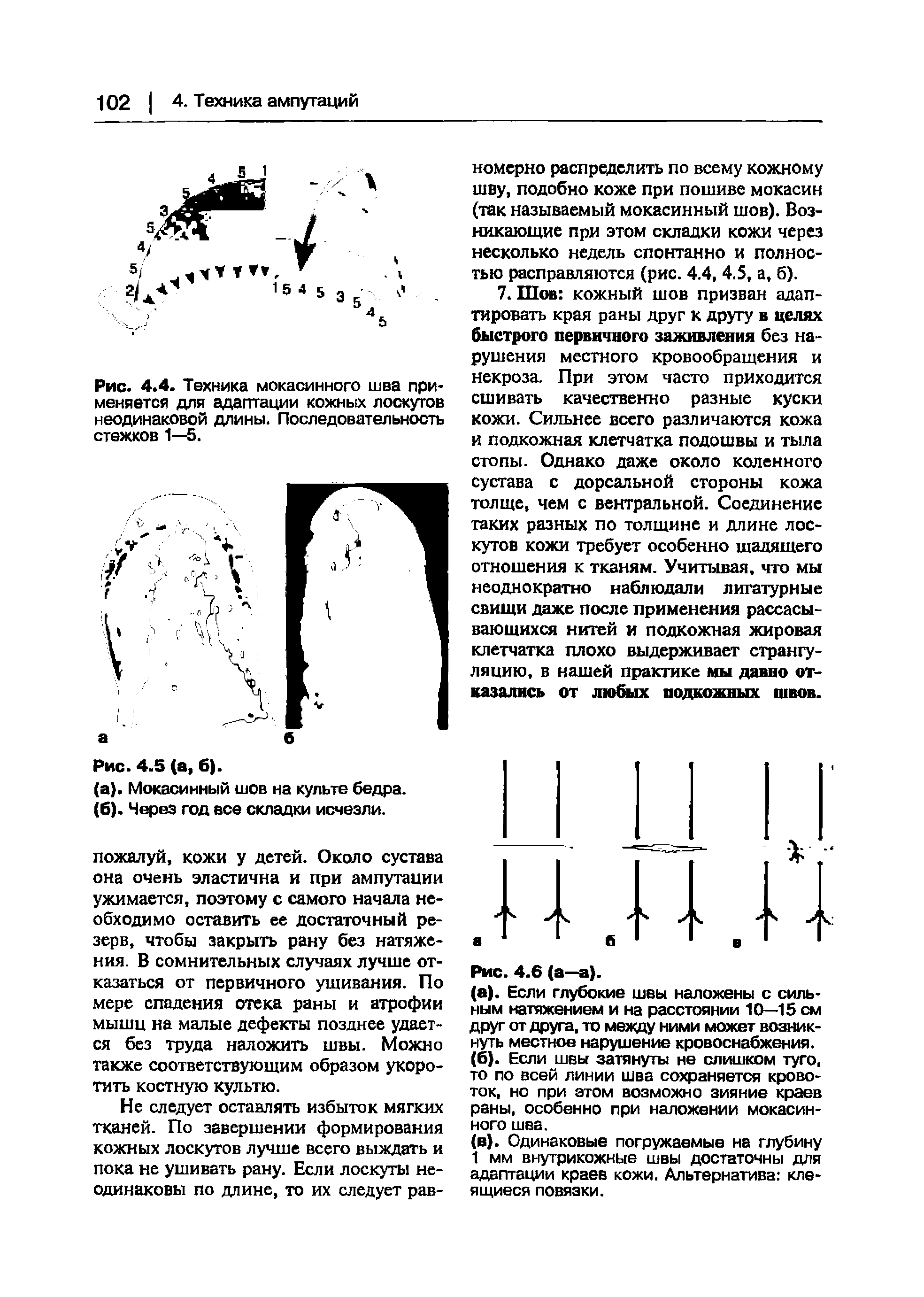 Рис. 4.4. Техника мокасинного шва применяется для адаптации кожных лоскутов неодинаковой длины. Последовательность стежков 1—5.