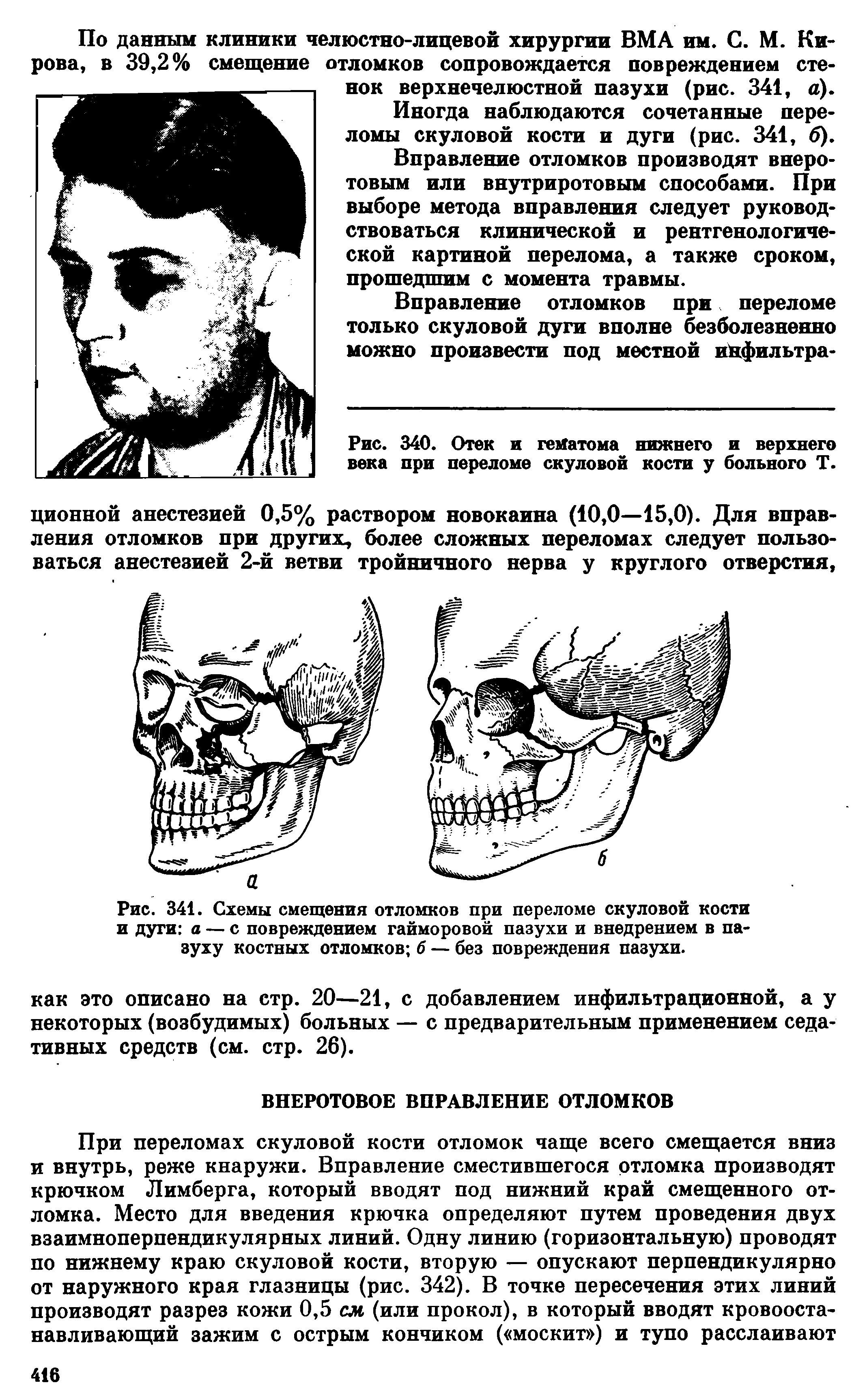 Рис. 341. Схемы смещения отломков при переломе скуловой кости и дуги а — с повреждением гайморовой пазухи и внедрением в пазуху костных отломков б — без повреждения пазухи.