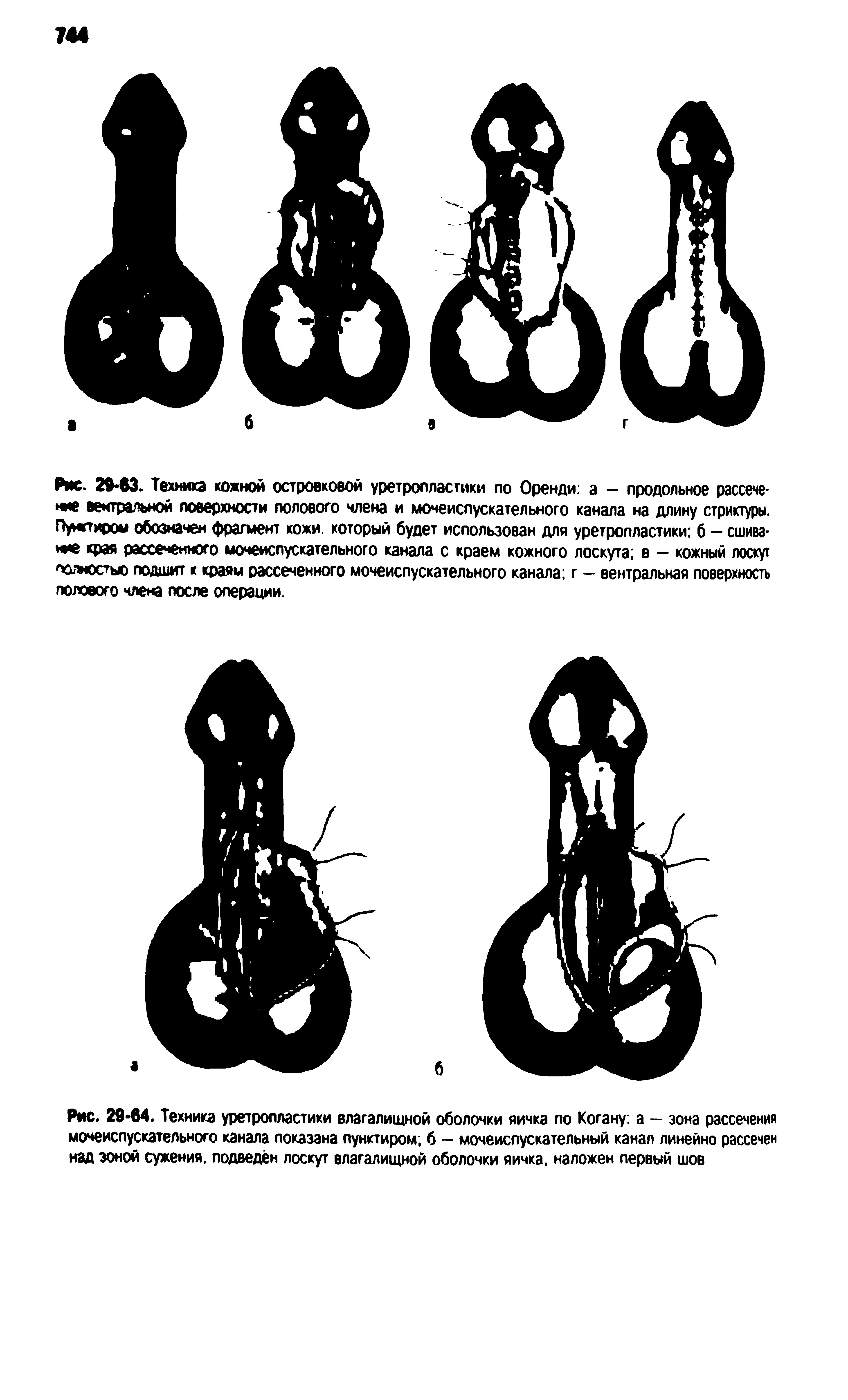 Рис. 29-64. Техника уретропластики влагалищной оболочки яичка по Когану а — зона рассечения мочеиспускательного канала показана пунктиром б - мочеиспускательный канал линейно рассечен над зоной сужения, подведён лоскут влагалищной оболочки яичка, наложен первый шов...