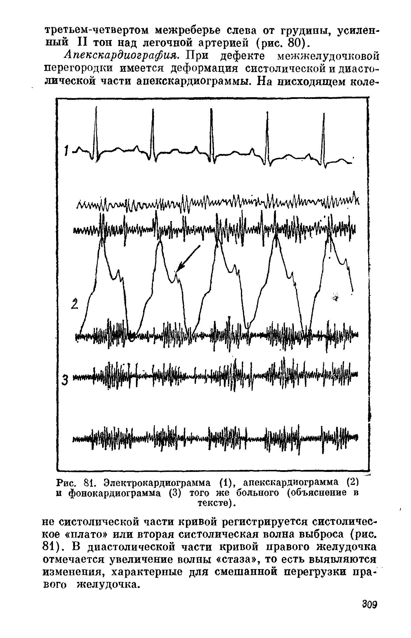 Рис. 81. Электрокардиограмма (1), апекскардиограмма (2) и фонокардиограмма (3) того ясе больного (объяснение в тексте).