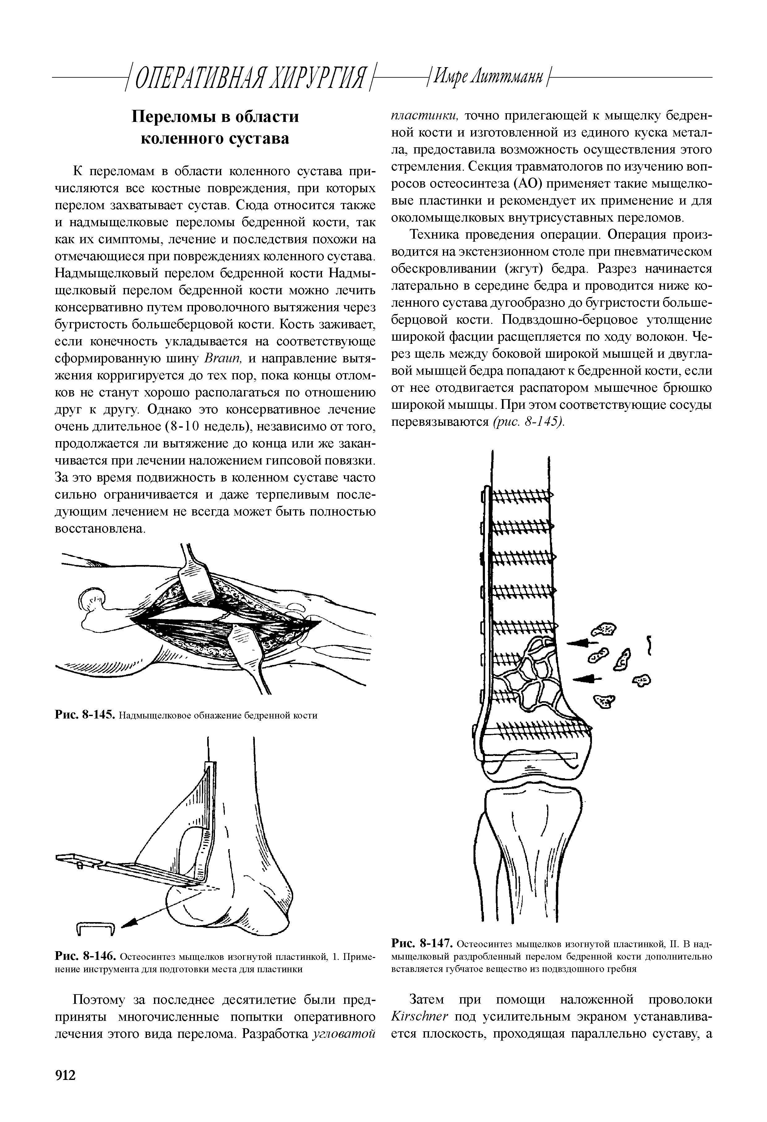 Рис. 8-147. Остеосинтез мыщелков изогнутой пластинкой, II. В надмыщелковый раздробленный перелом бедренной кости дополнительно вставляется губчатое вещество из подвздошного гребня...