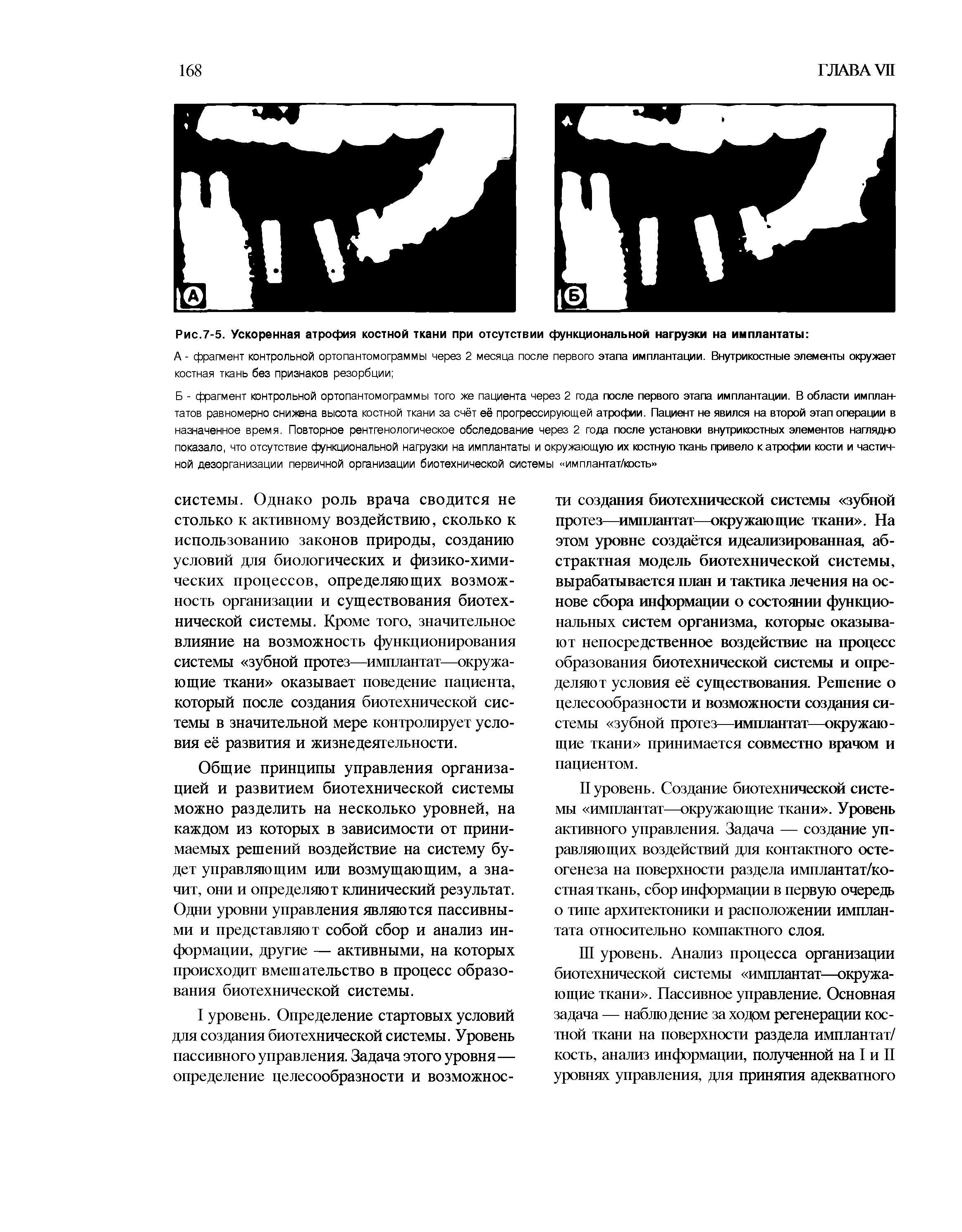 Рис.7-5. Ускоренная атрофия костной ткани при отсутствии функциональной нагрузки на имплантаты ...