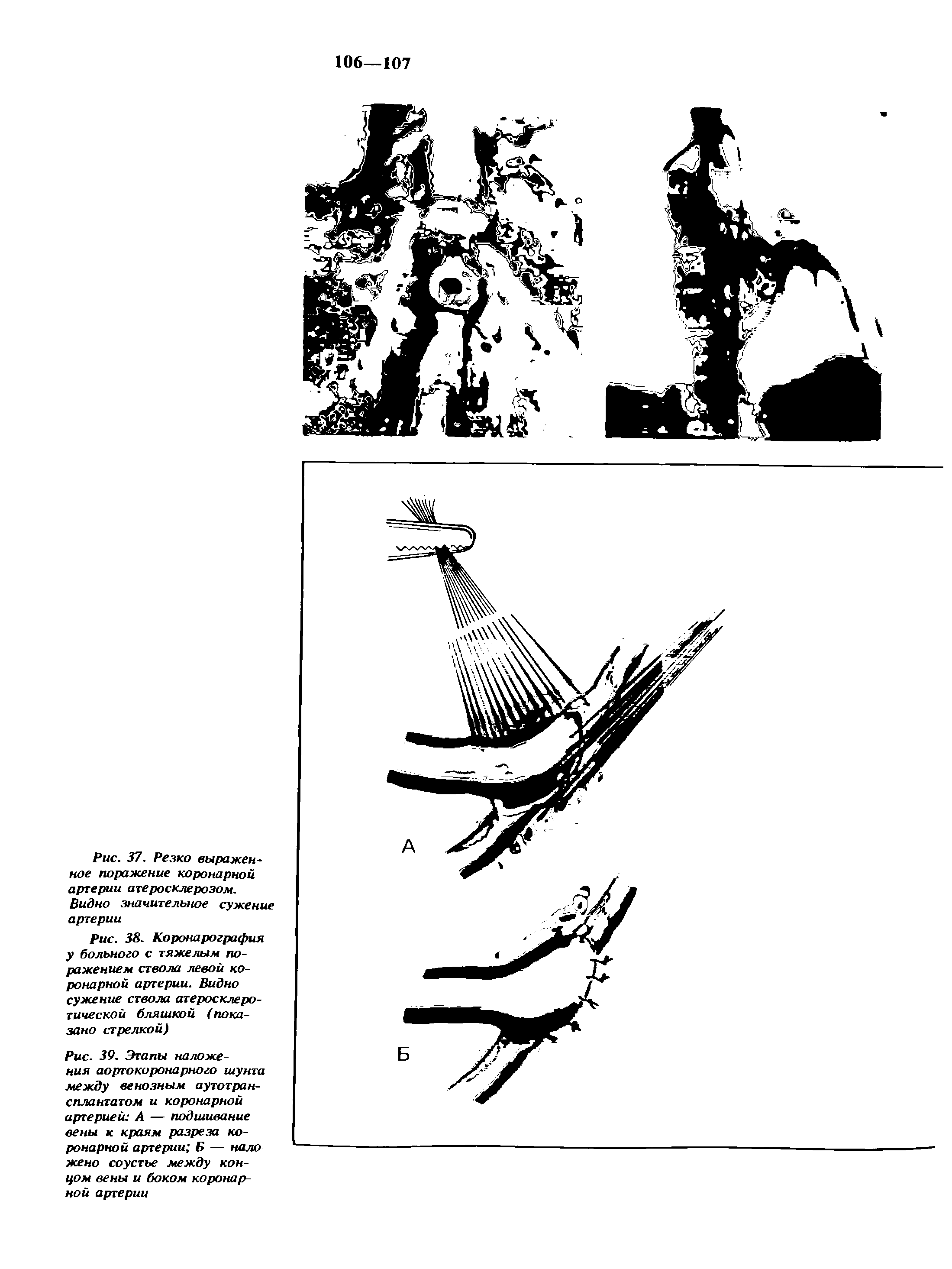 Рис. 39. Этапы наложения аортокоронарного шунта между венозным аутотрансплантатом и коронарной артерией А — подшивание вены к краям разреза коронарной артерии Б — наложено соустье между концом вены и боком коронарной артерии...