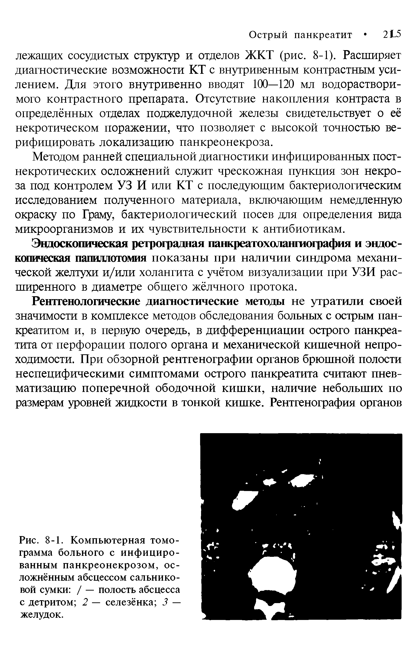 Рис. 8-1. Компьютерная томограмма больного с инфицированным панкреонекрозом, осложнённым абсцессом сальниковой сумки / — полость абсцесса с детритом 2 — селезёнка 3 — желудок.