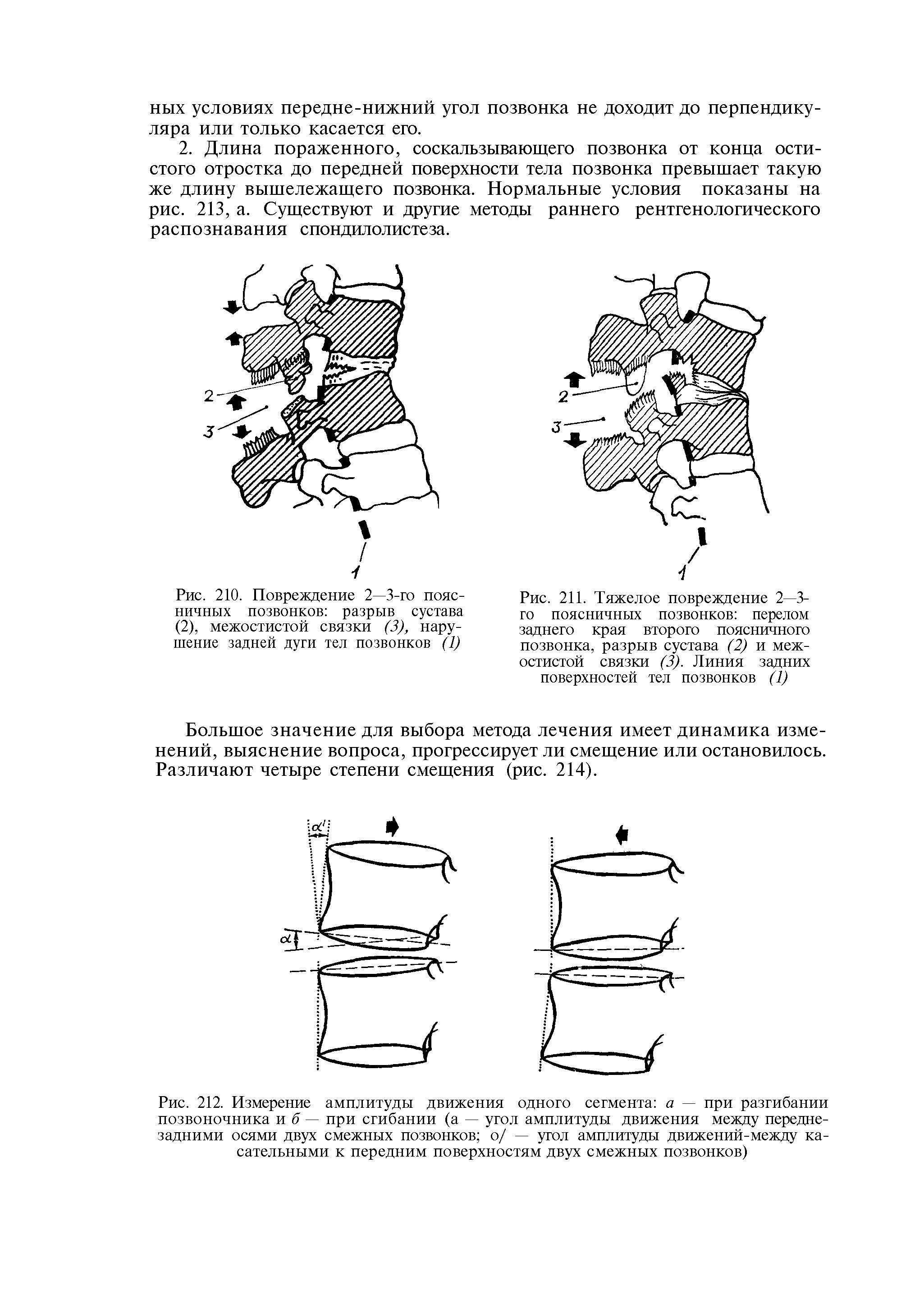 Рис. 210. Повреждение 2—3-го поясничных позвонков разрыв сустава (2), межостистой связки (3), нарушение задней дуги тел позвонков (1)...