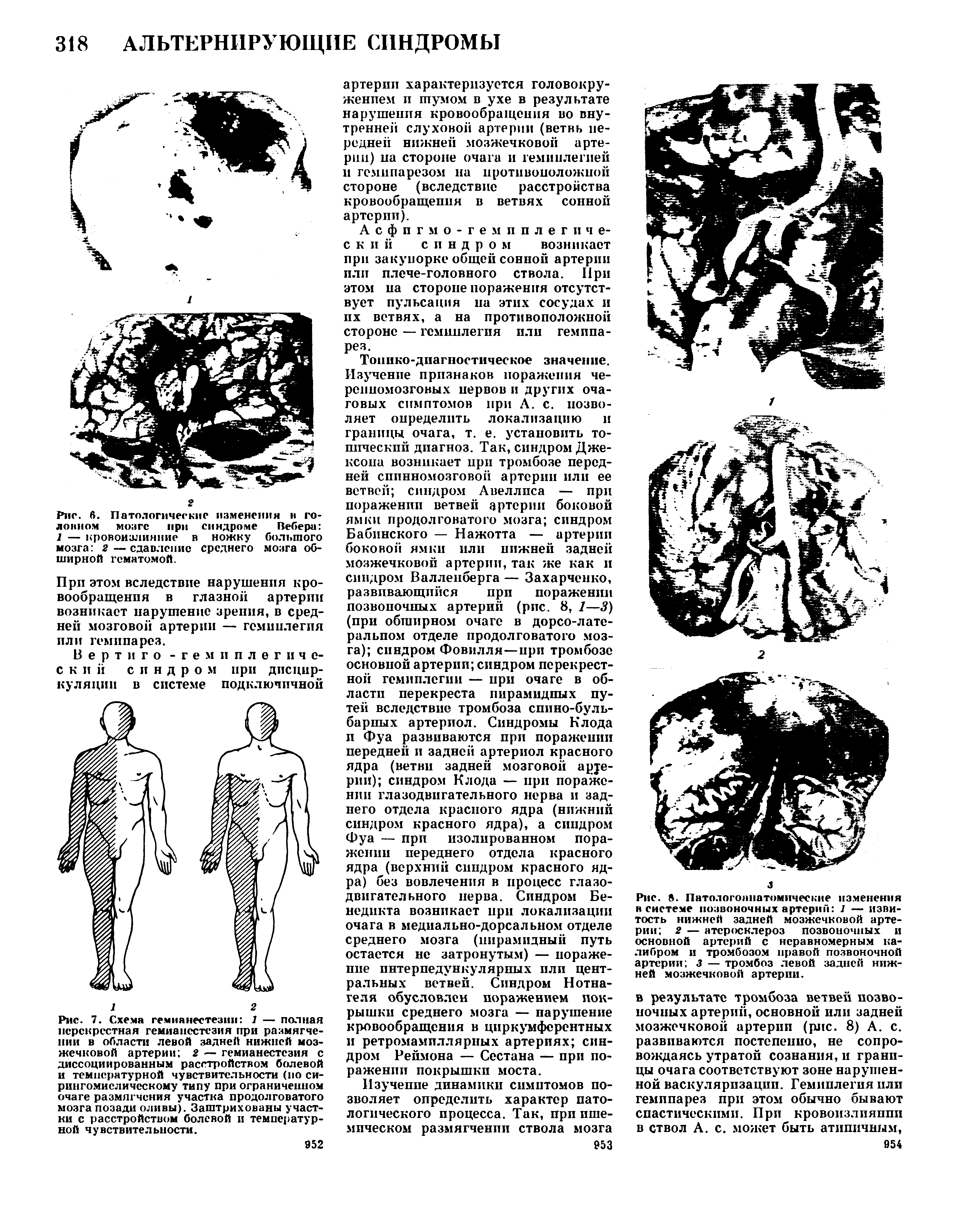 Рис. 6. Патологические изменения в головном мозге при синдроме Вебера 1 — кровоизлияние в ножку большого мозга 2 — сдавление среднего мозга обширной гематомой.