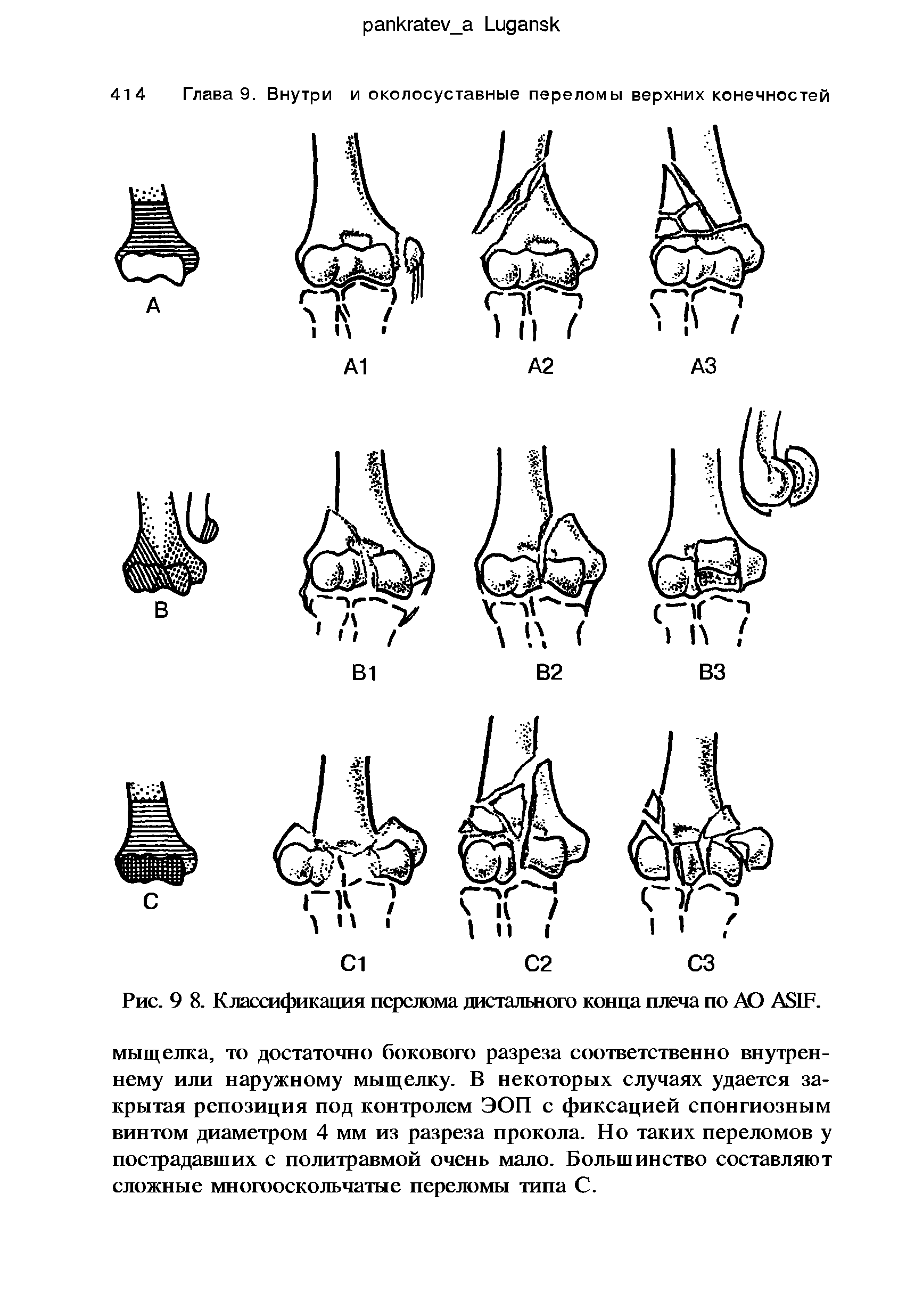 Рис. 9 8. Классификация перелома дистального конца плеча по АО ASIF.