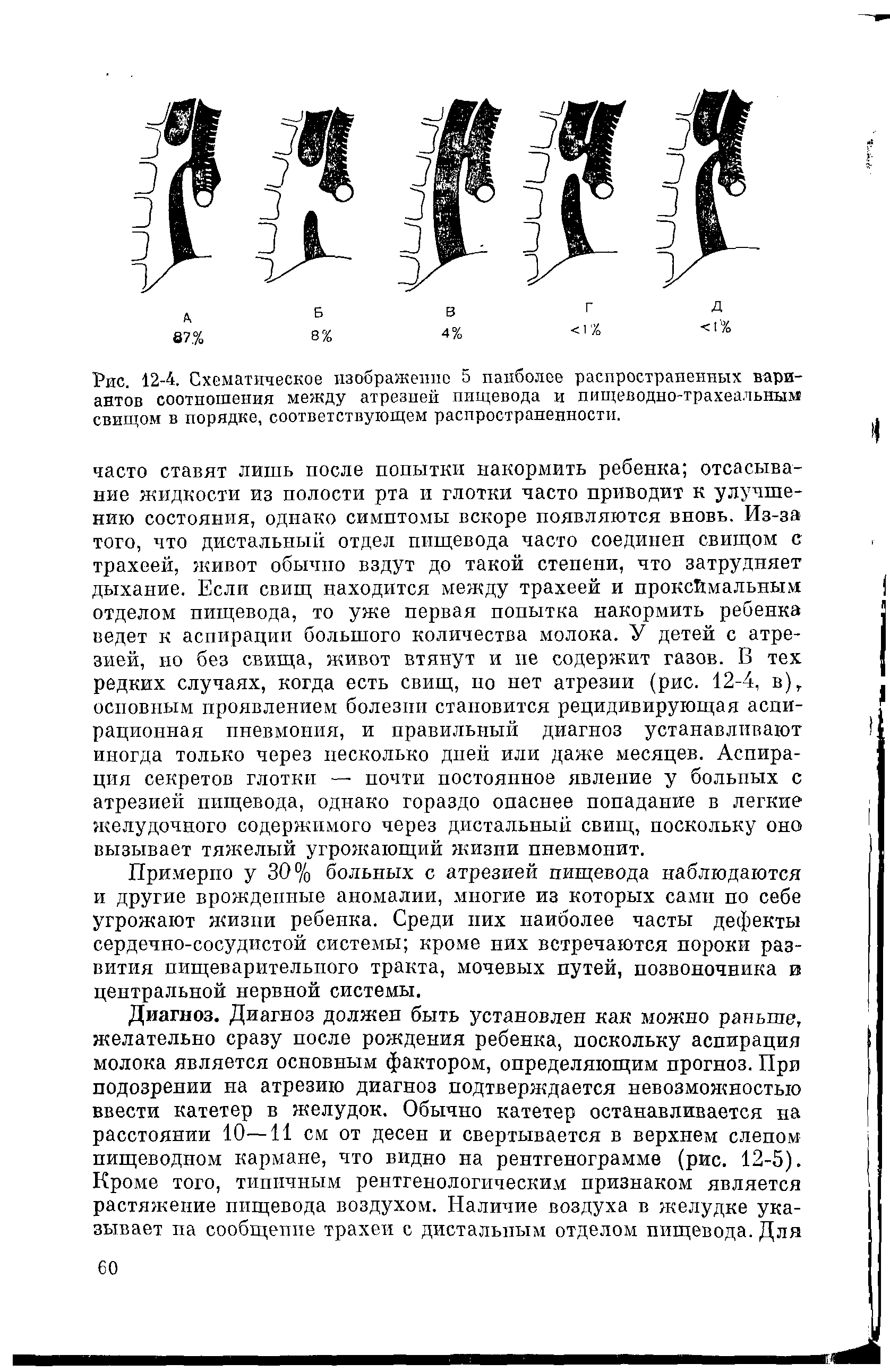 Рис. 12-4. Схематическое изображение 5 наиболее распространенных вариантов соотношения между атрезией пищевода и пищеводно-трахеальным свищом в порядке, соответствующем распространенности.