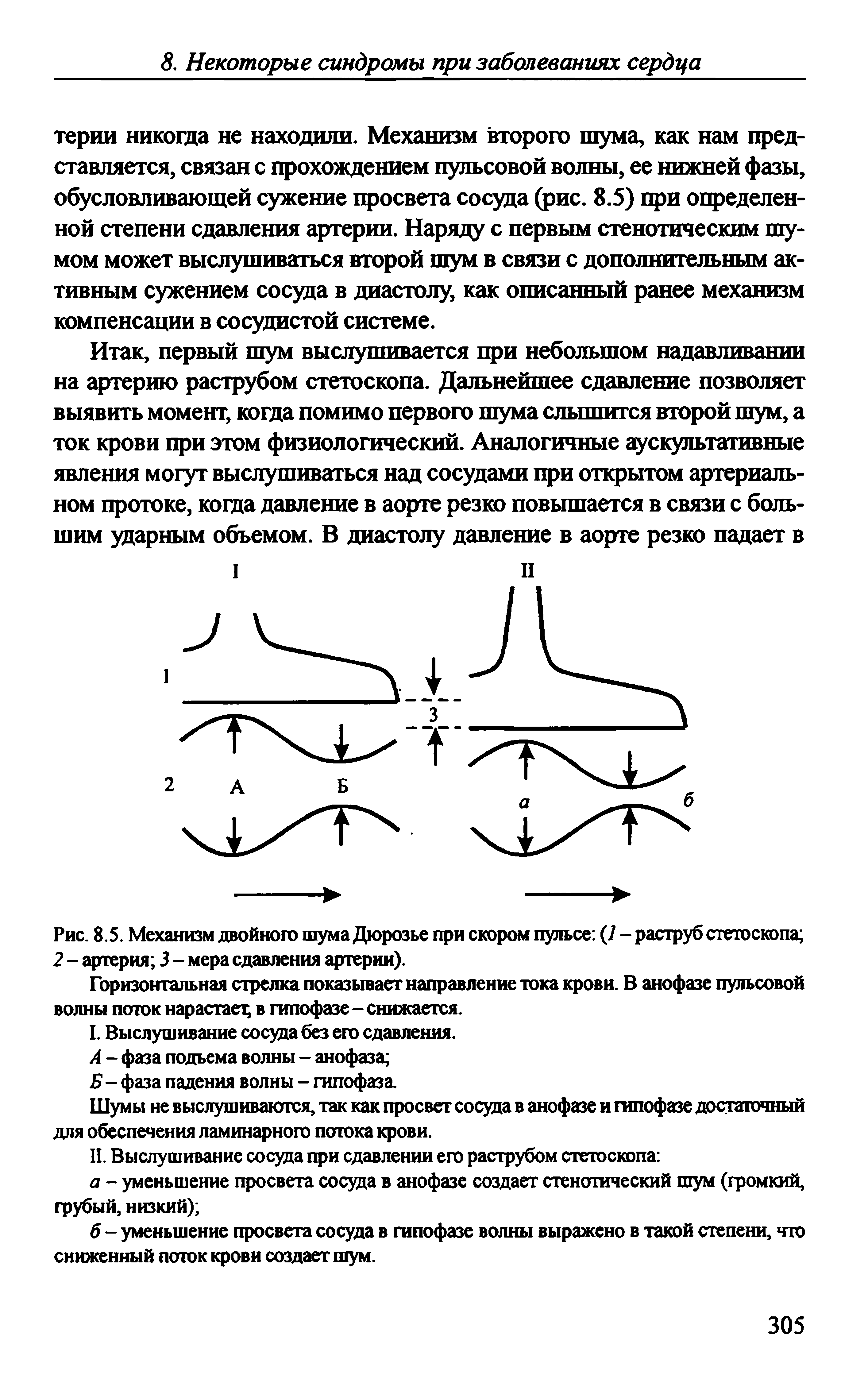 Рис. 8.5. Механизм двойного шума Дюрозье при скором пульсе (7 - раструб стетоскопа 2 - артерия 3 - мера сдавления артерии).