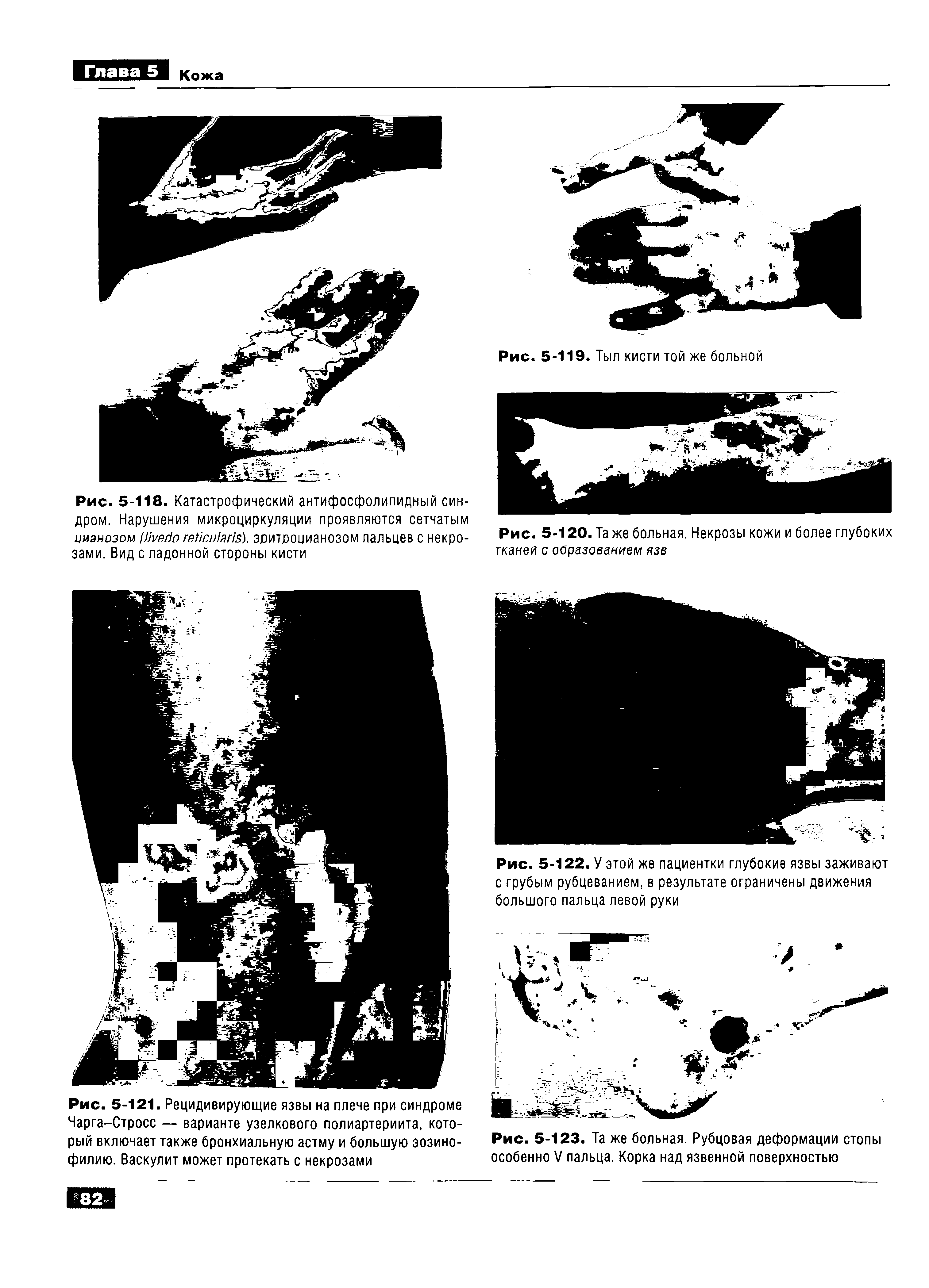 Рис. 5-118. Катастрофический антифосфолипидный синдром. Нарушения микроциркуляции проявляются сетчатым цианозом IJ . эдитдоцианозом пальцев с некрозами. Вид с ладонной стороны кисти...