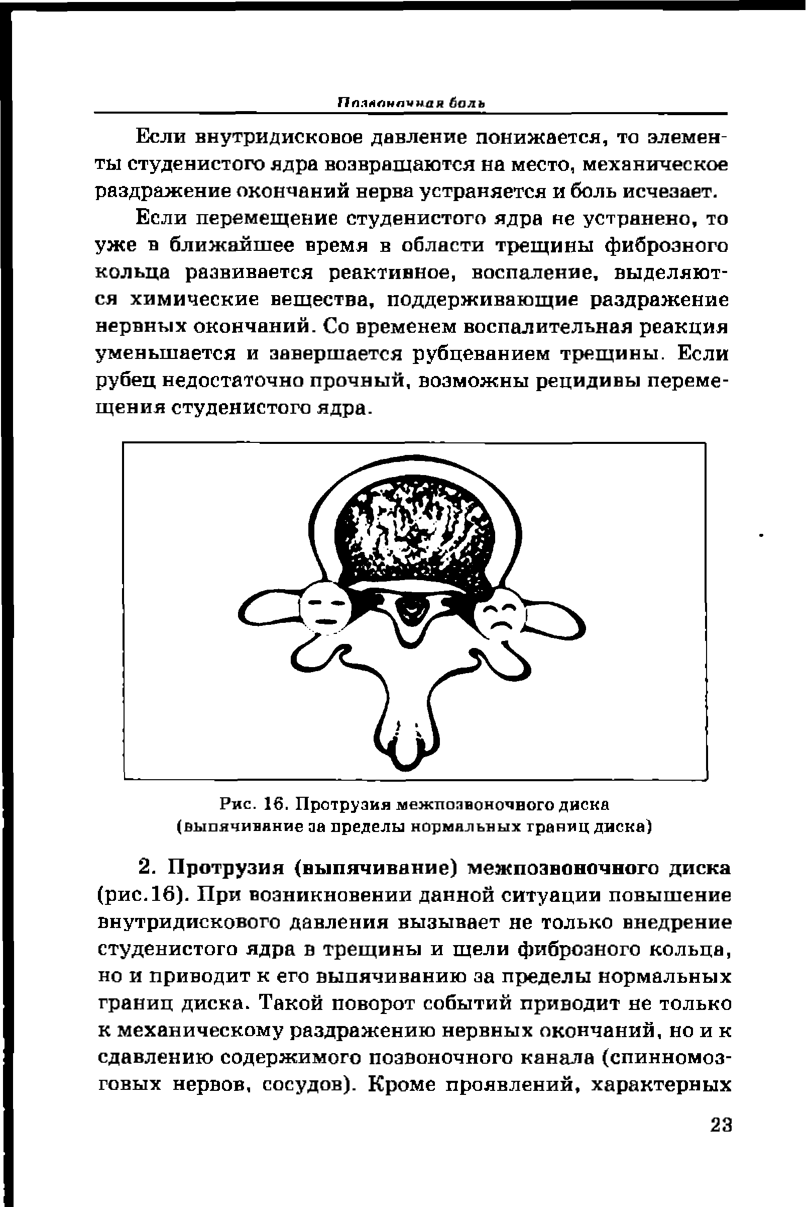 Рис. 16. Протрузия межпозвоночного диска (выпячивание за пределы нормальных границ диска)...