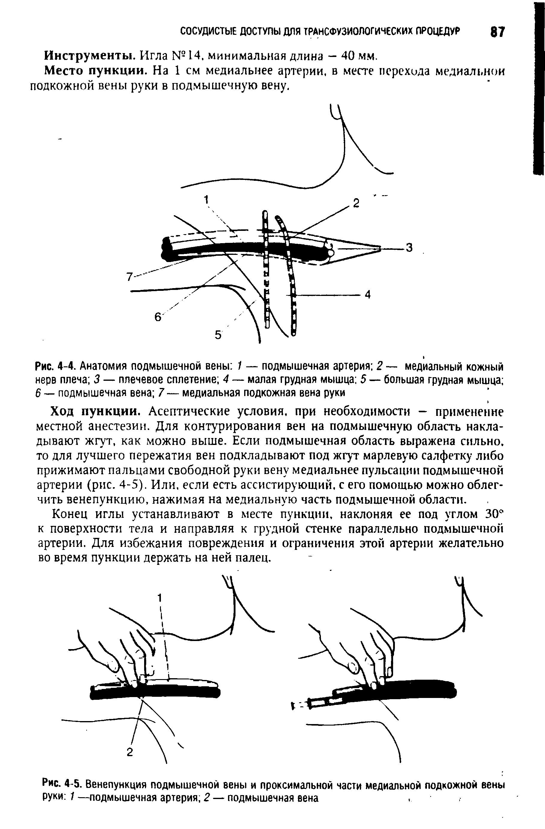 Рис. 4-4. Анатомия подмышечной вены 1 — подмышечная артерия 2 — медиальный кожный нерв плеча 3 — плечевое сплетение 4 — малая грудная мышца 5 — большая грудная мышца 6 — подмышечная вена 7 — медиальная подкожная вена руки...