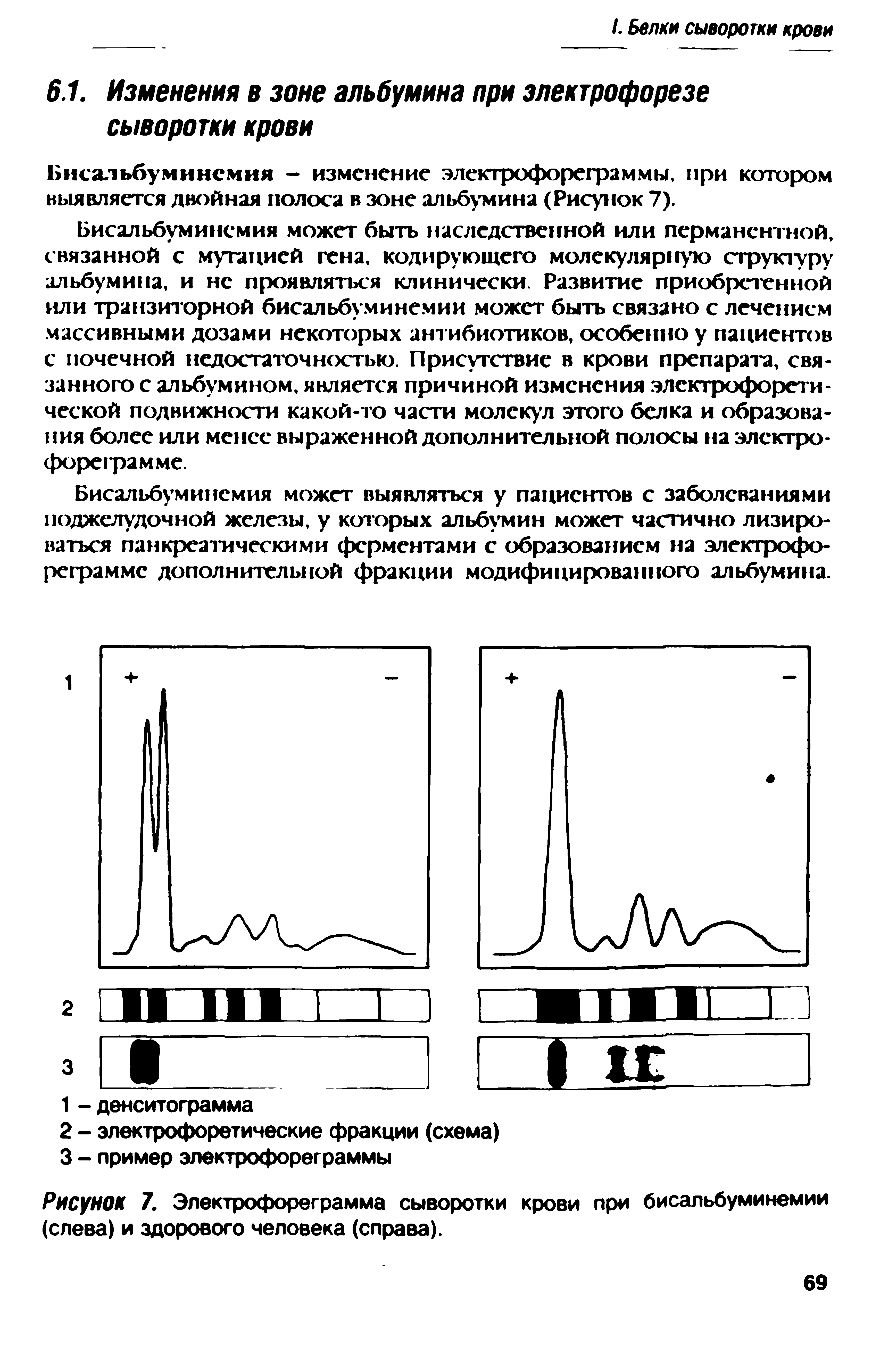 Рисунок 7. Электрофореграмма сыворотки крови при бисальбуминемии (слева) и здорового человека (справа).